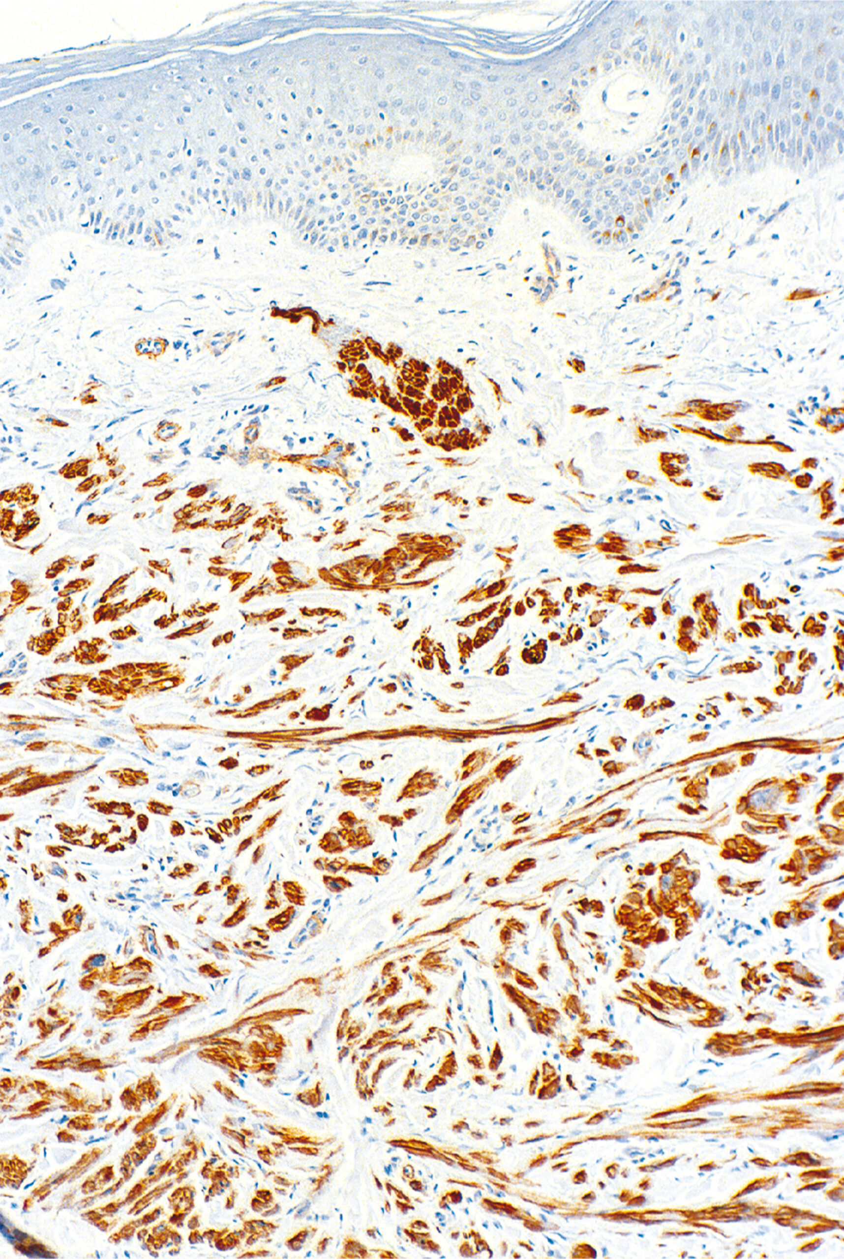A histological section with immunostain highlighting irregular bundles and clusters of spindle cells beneath the epidermis.