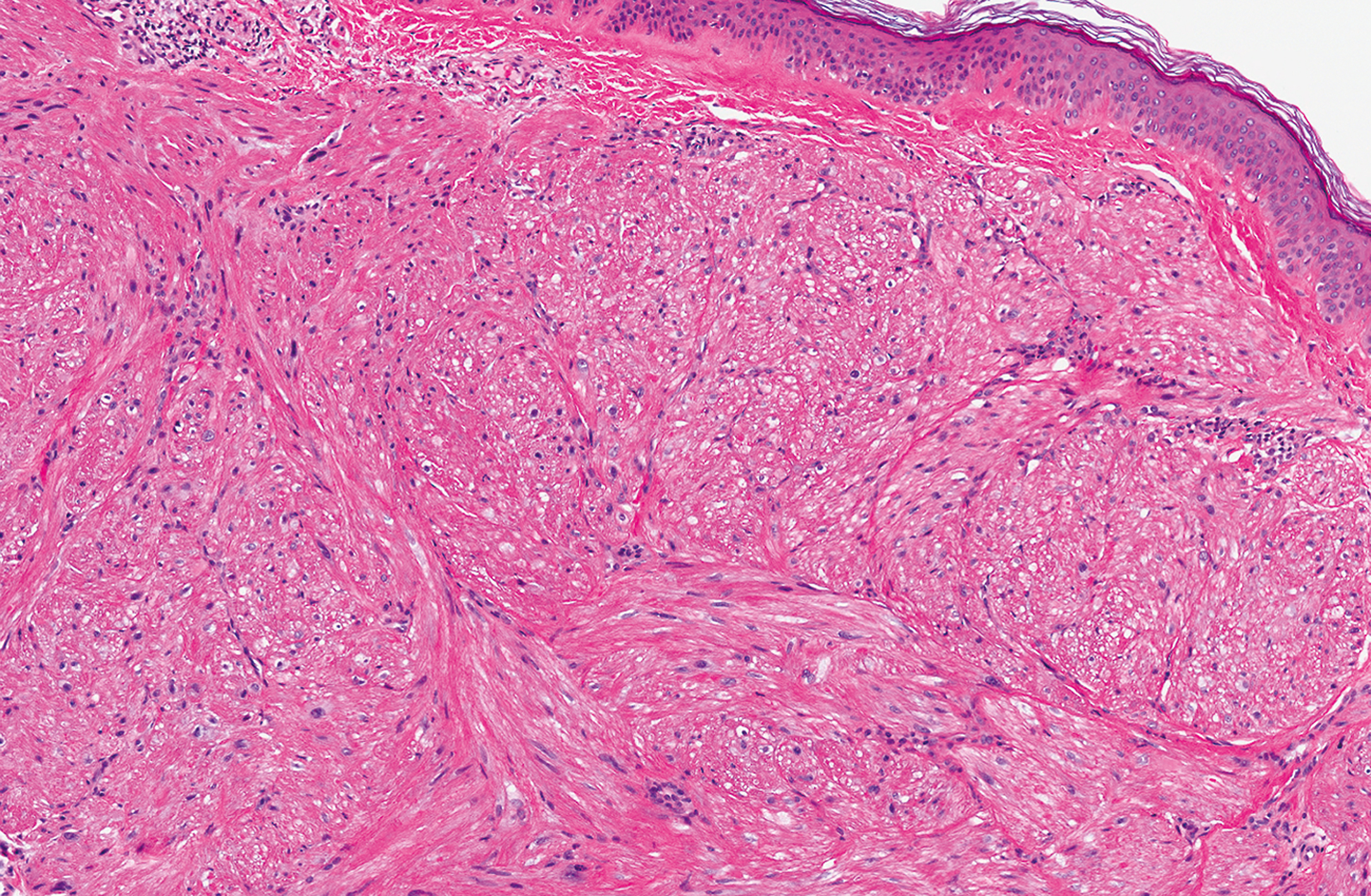 A histological section of dermis with multiple intersecting fascicles of spindle cells beneath an unremarkable epidermis.