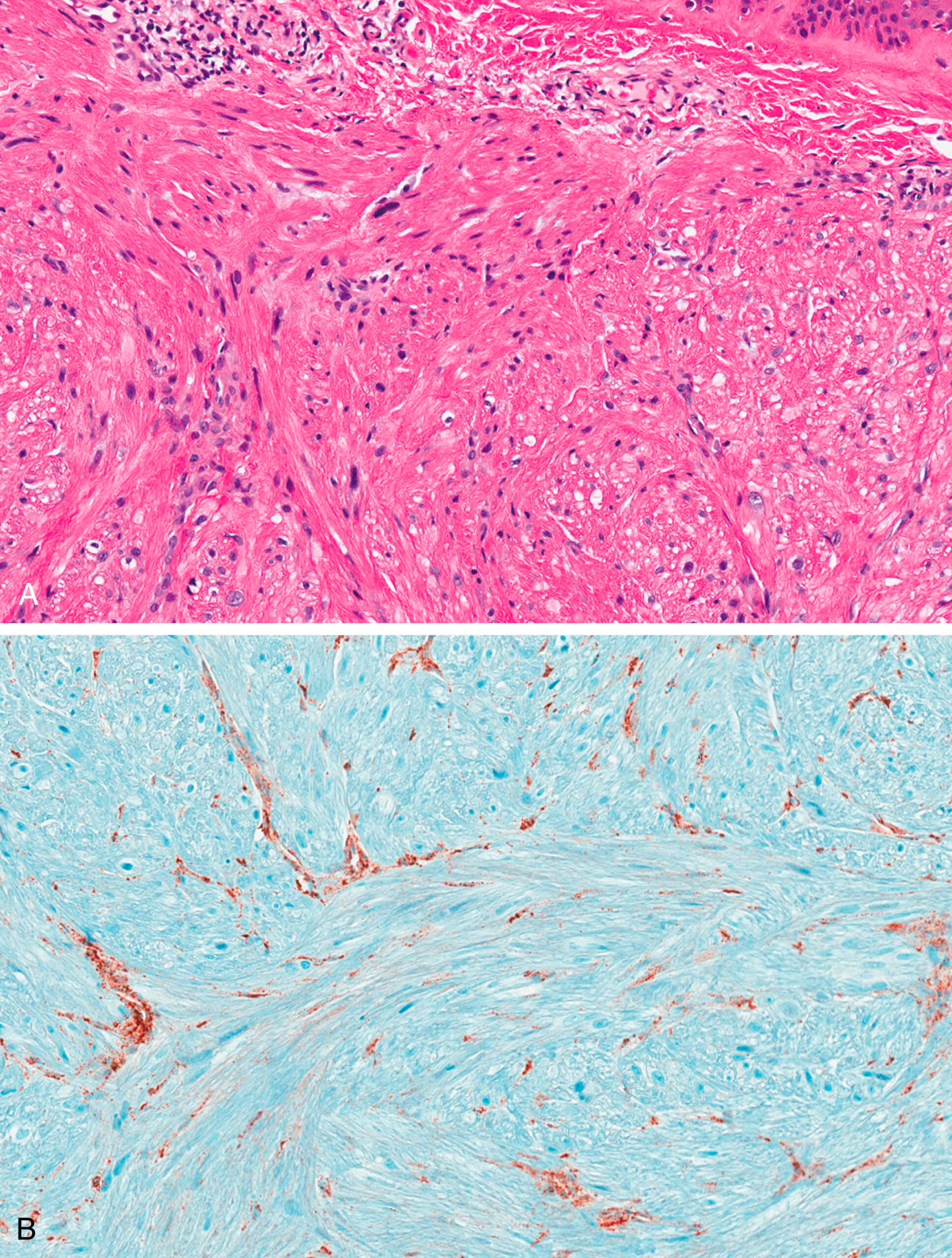 A set of two views labeled with A and B shows hereditary leiomyoma with nuclear atypia in hematoxylin and eosin stain and patchy enzyme retention in immunohistochemical stain for fumarate hydratase.