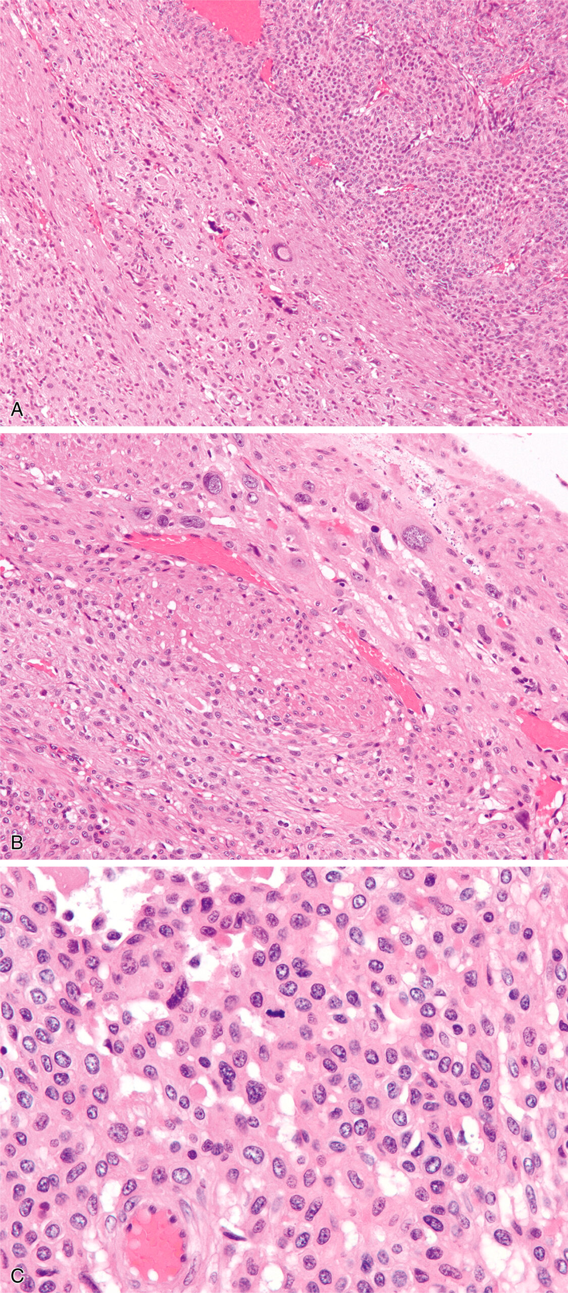 A set of 3 histologic views labeled with A, B, and C shows a malignant glomus tumor adjacent to fumarate hydratase deficient leiomyoma with progressive magnification from low to high power fields.
