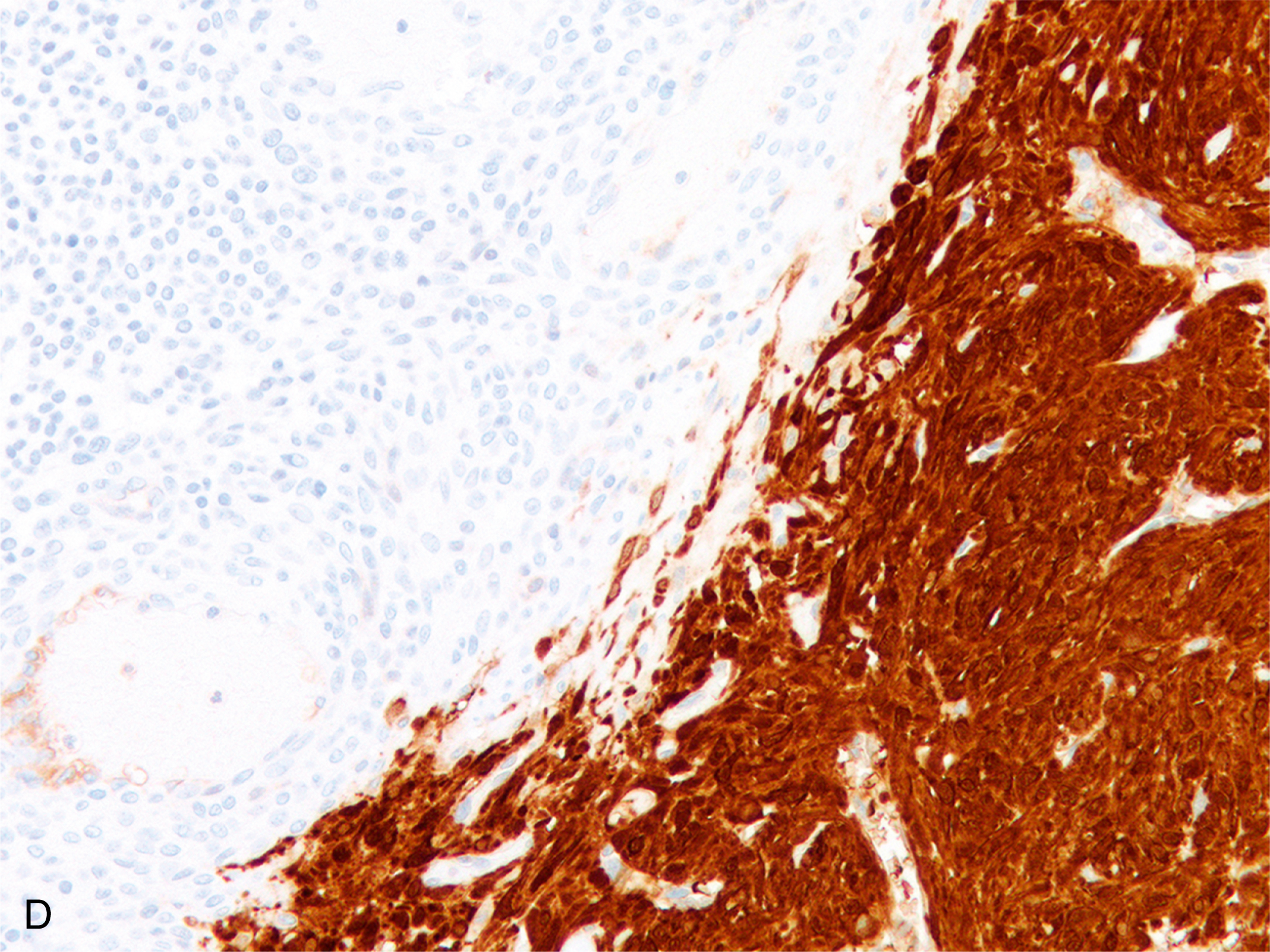 A set of 3 histologic views labeled with A, B, and C shows a malignant glomus tumor adjacent to fumarate hydratase deficient leiomyoma with progressive magnification from low to high power fields.