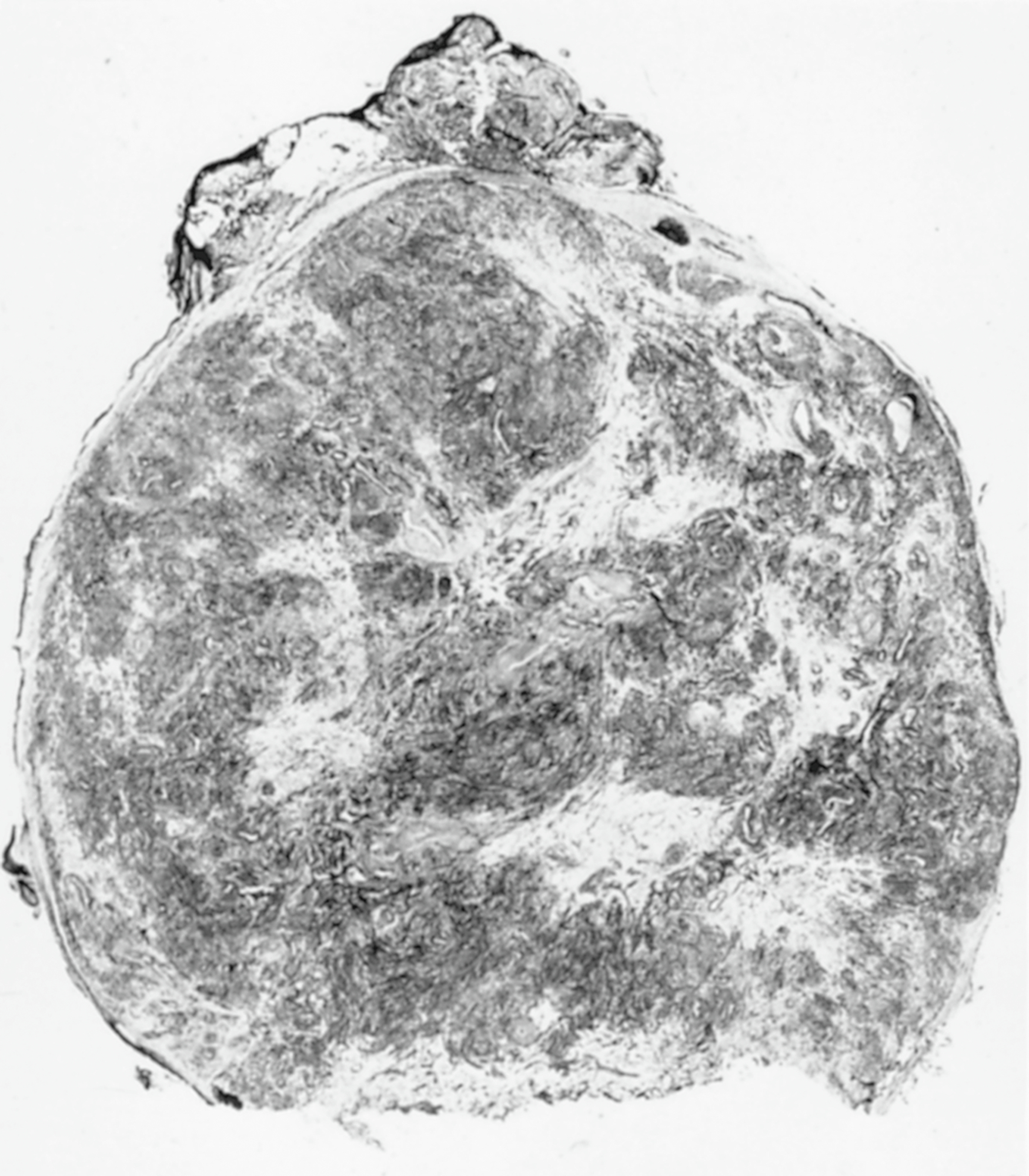 A rounded subcutaneous tumor with dense central regions containing thick walled vessels and peripheral areas of mixed smooth muscle and stromal tissue.