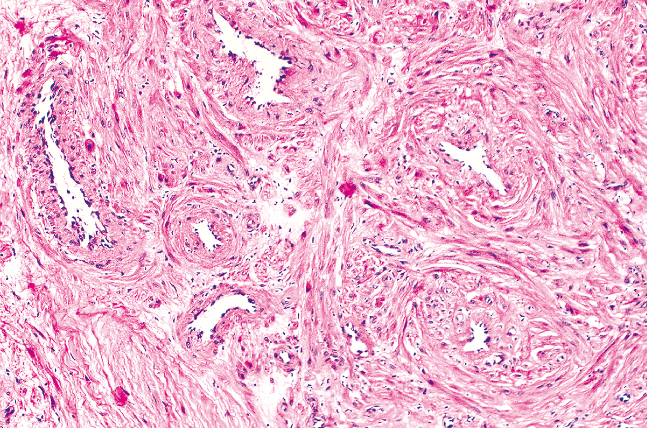 A microscopic view of vascular structures with circumferentially arranged inner smooth muscle layers and outer areas merging with disorganized smooth muscle tissue.