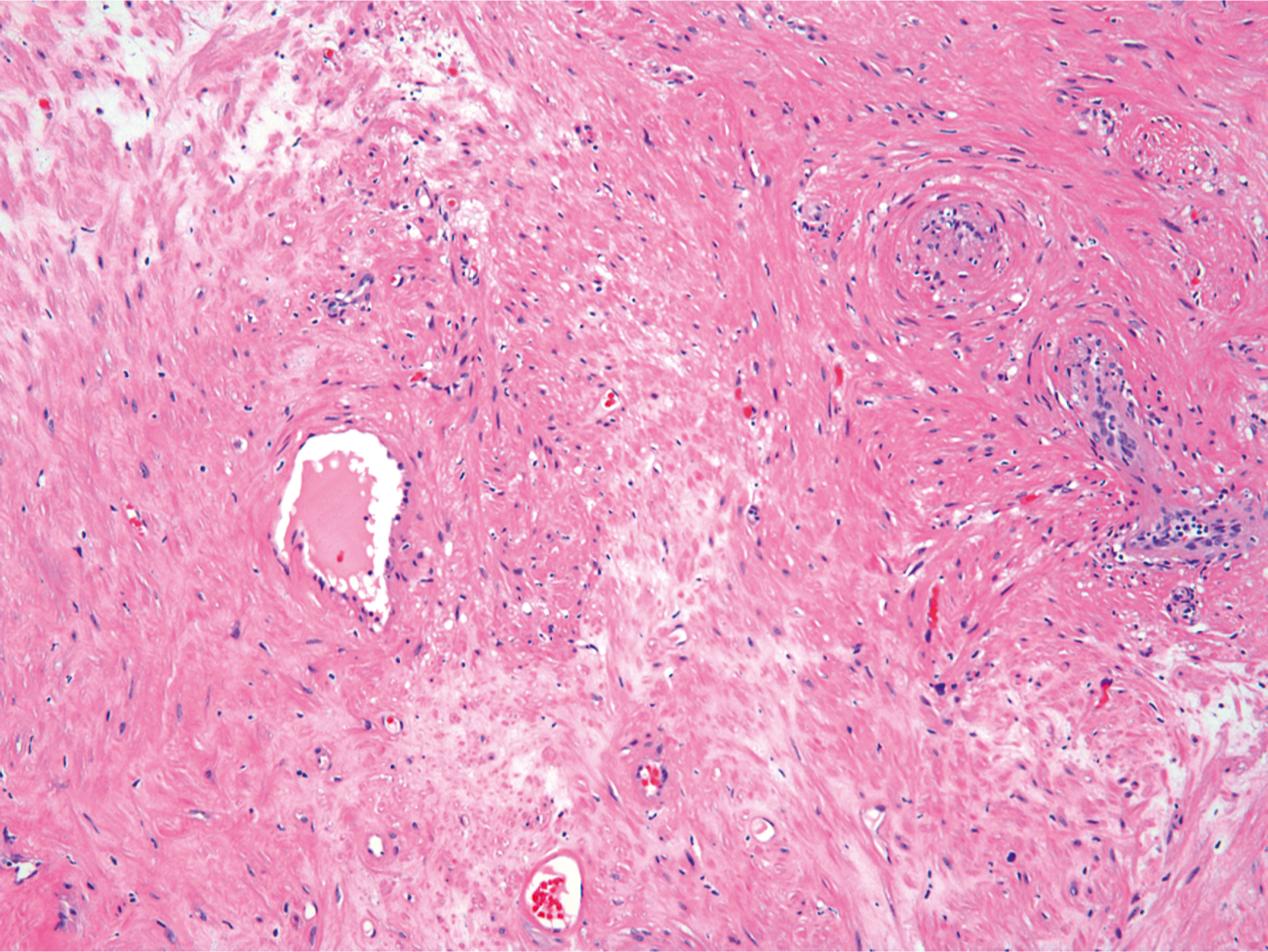 A microscopic view of thick walled vessels separated by stromal areas containing interstitial fluid accumulation and scattered spindle shaped cells.