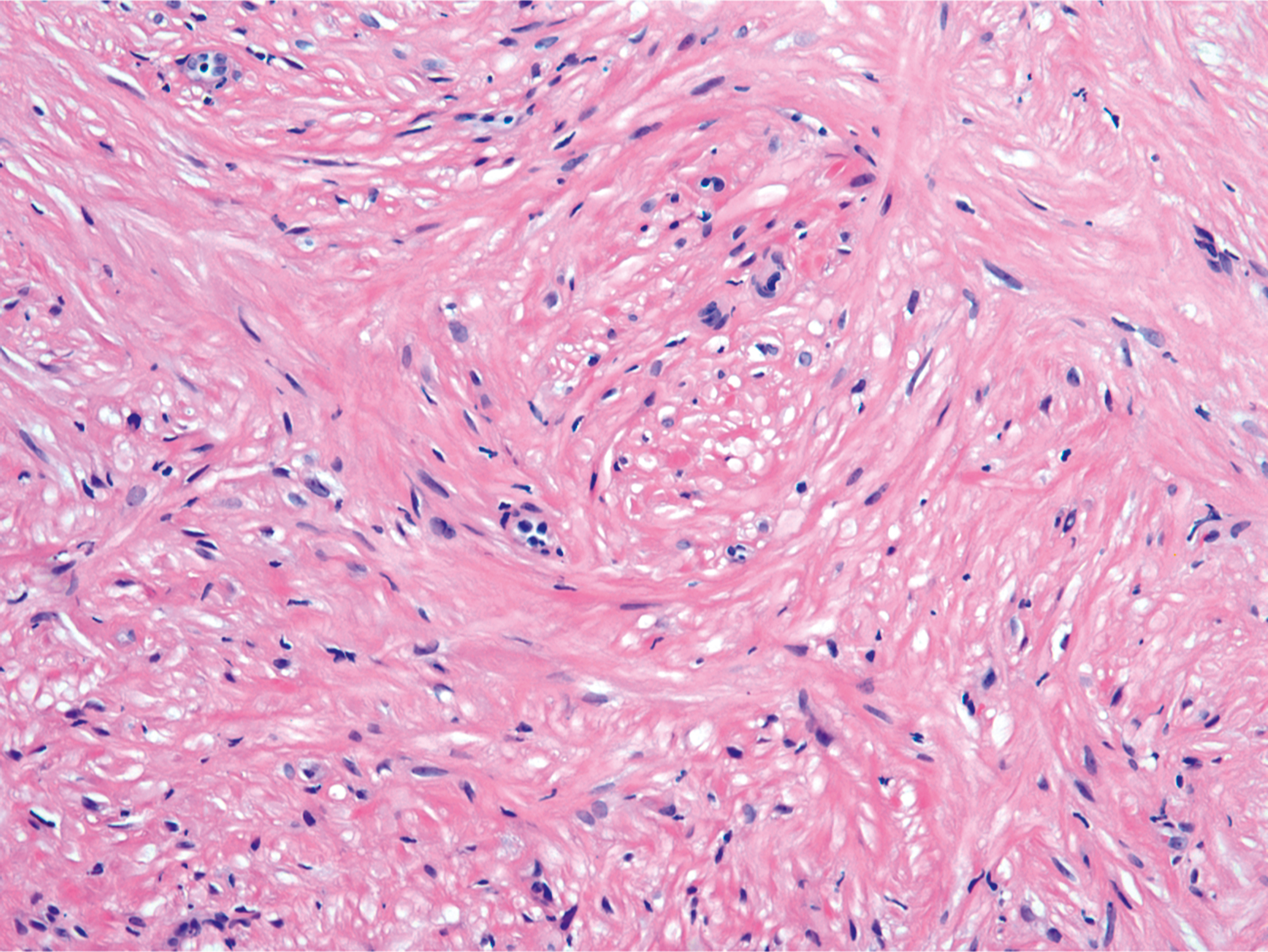 A section of angioleiomyoma with intersecting fascicles of mature smooth muscle cells and the presence of vacuolar change in several cells.