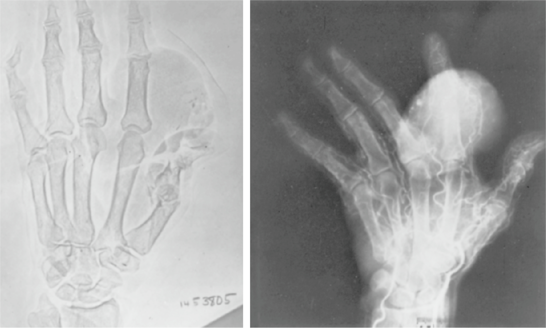 A set of two radiographs of a hand, with one showing multiple finger bones and the other showing a soft tissue mass with calcification near the fingers.