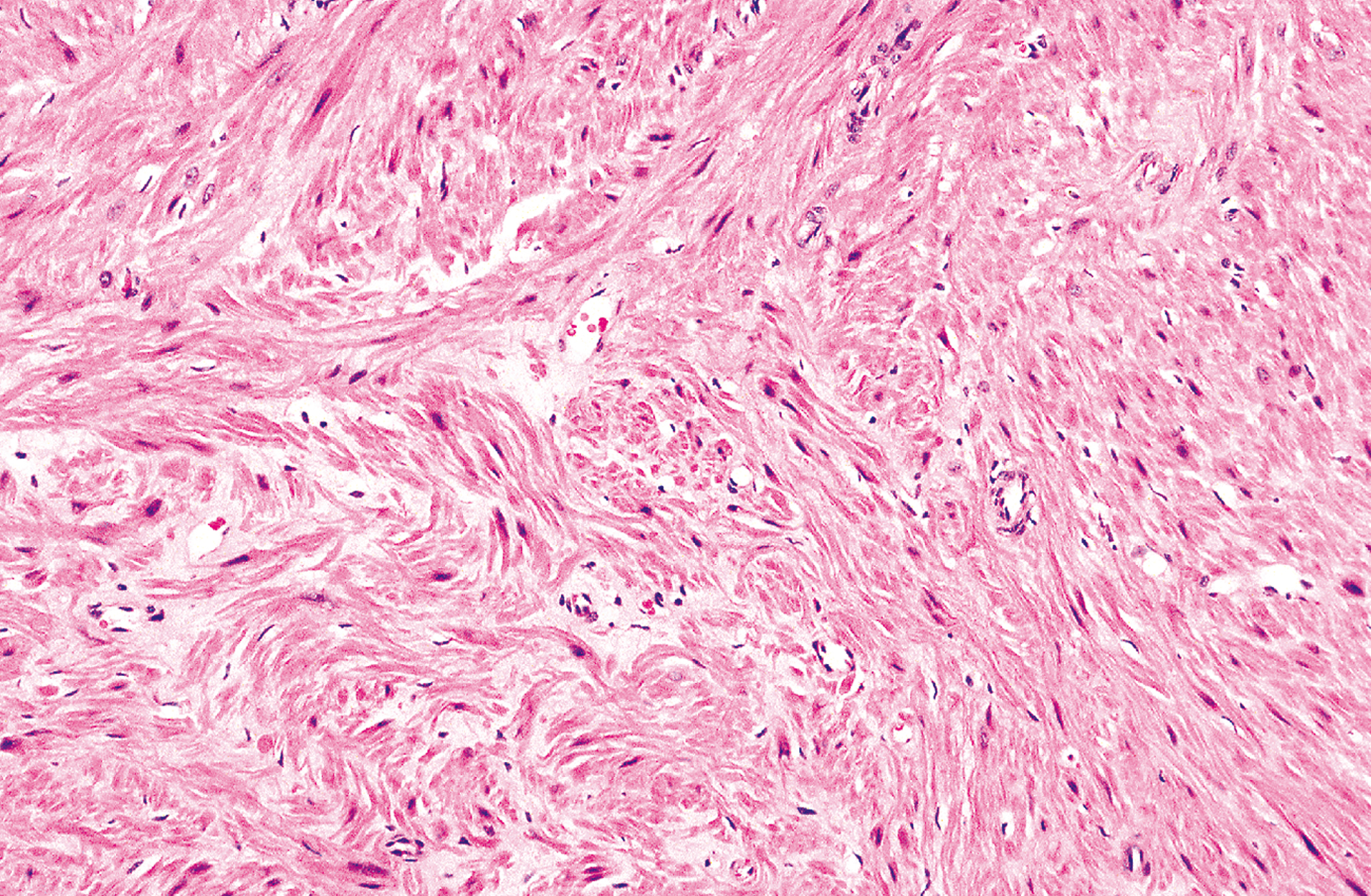 A microscopic view of somatic leiomyoma with interlacing fascicles of smooth muscle cells that appear less uniformly oriented across the tissue section.