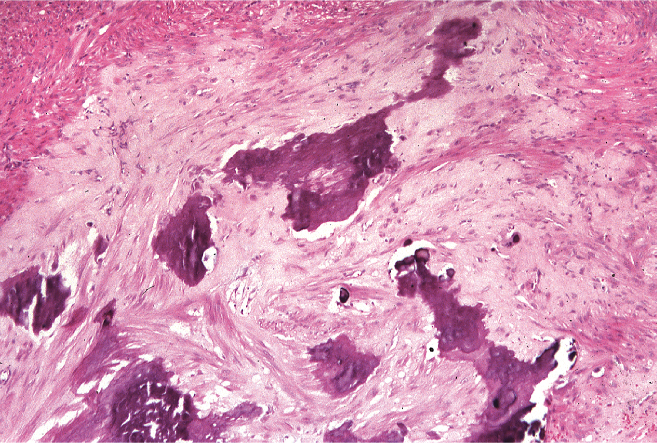 A section of somatic leiomyoma with smooth muscle bundles and multiple irregular calcified areas scattered within the soft tissue.
