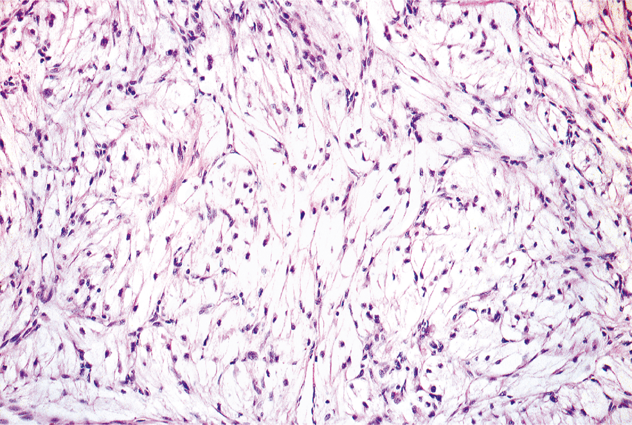 A microscopic view of somatic leiomyoma with fascicles of smooth muscle cells and areas of clear cytoplasmic change within the soft tissue.