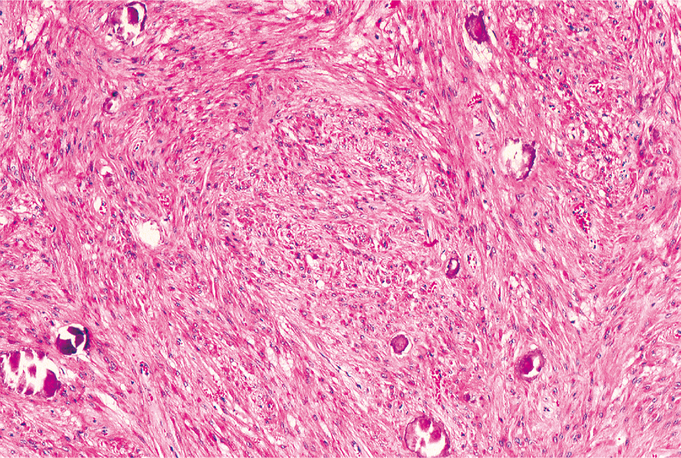 A microscopic section of somatic leiomyoma of soft tissue with fascicles of smooth muscle cells and multiple round psammomatous calcifications.