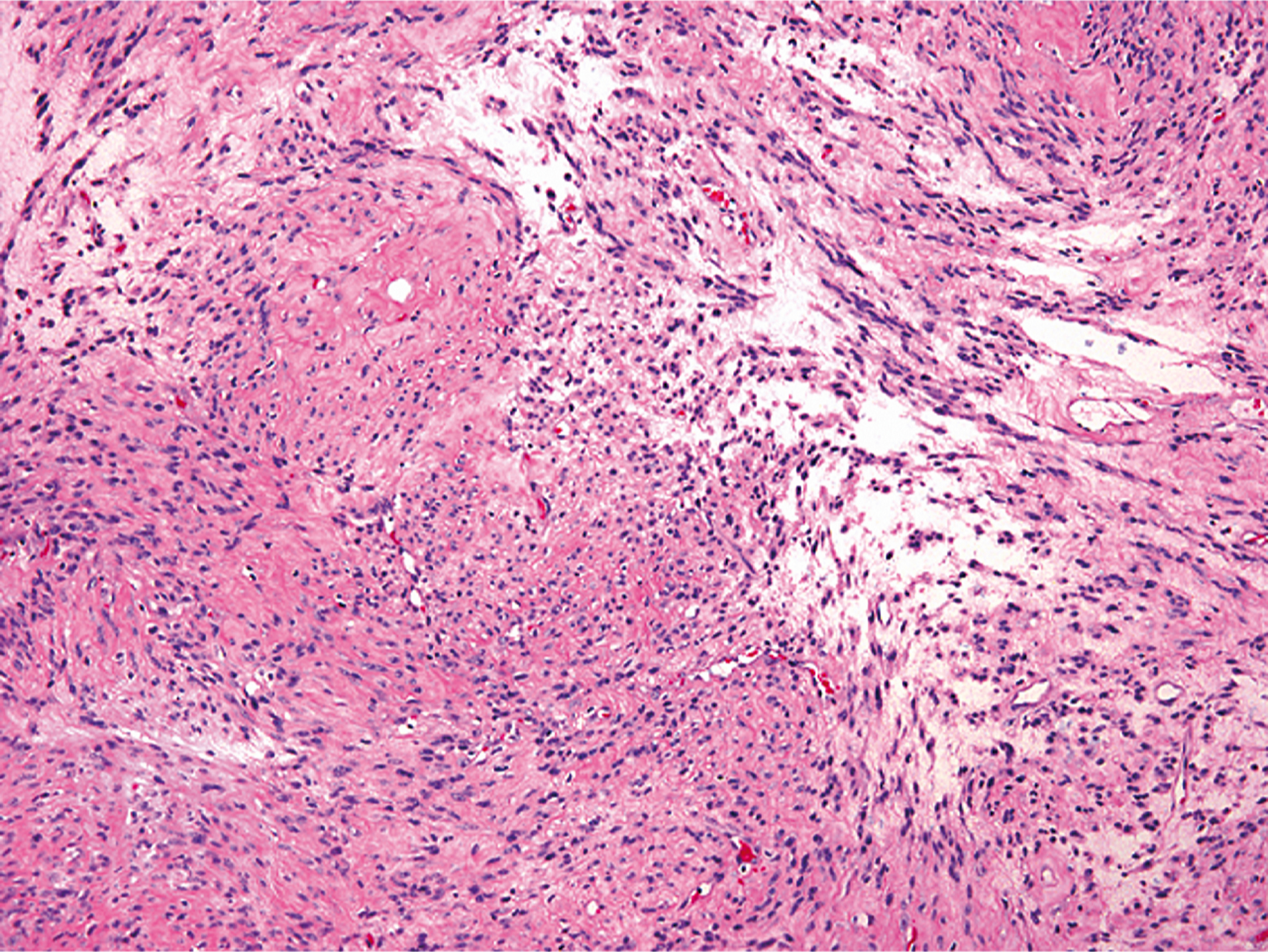 A section of gynecologic type leiomyoma with intersecting fascicles of smooth muscle cells and numerous thick walled blood vessels with areas of stromal hyalinization.