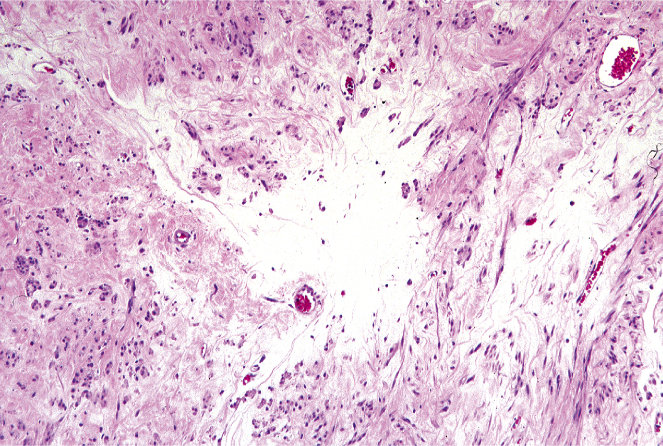 A section of gynecologic type leiomyoma with spindle shaped smooth muscle cells and a central area of hydropic change with scattered blood vessels.