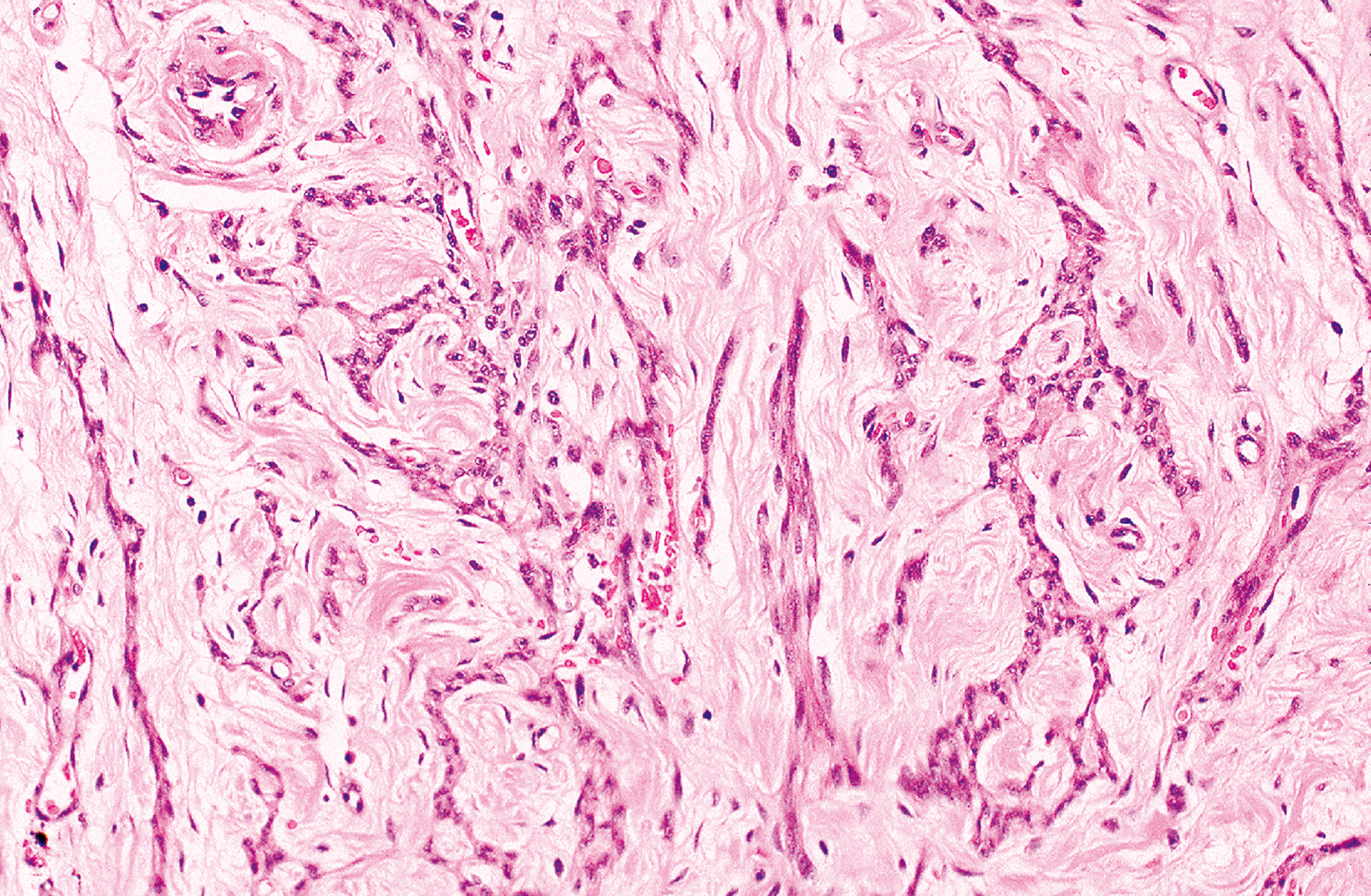 A view of gynecologic type leiomyoma with cordlike arrangement of spindle cells within a fibrous stroma and scattered oval nuclei.