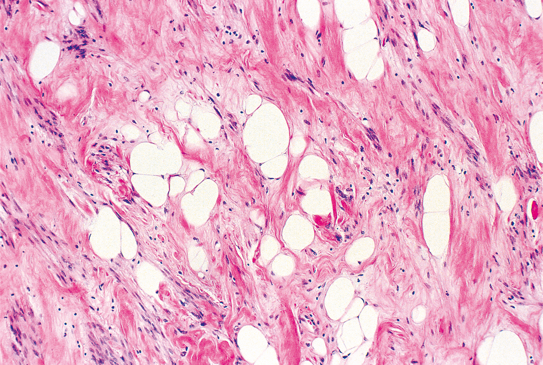 A section of gynecologic type leiomyoma with interspersed clusters of mature adipocytes within smooth muscle bundles.