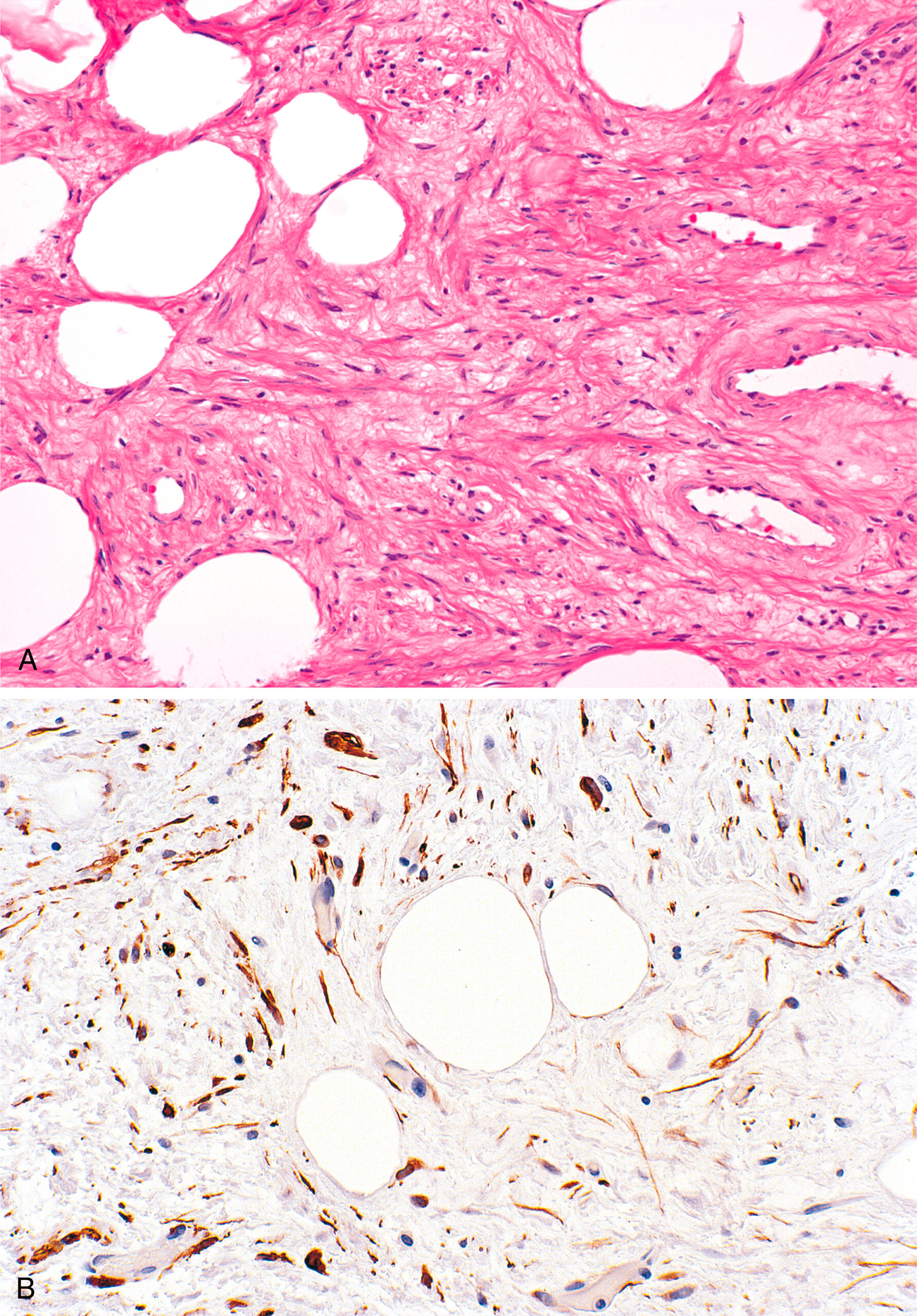 A set of two microscopic views labeled with A and B shows gynecologic type leiomyoma with mature muscle fibers among adipocytes and desmin expression in muscle cells.