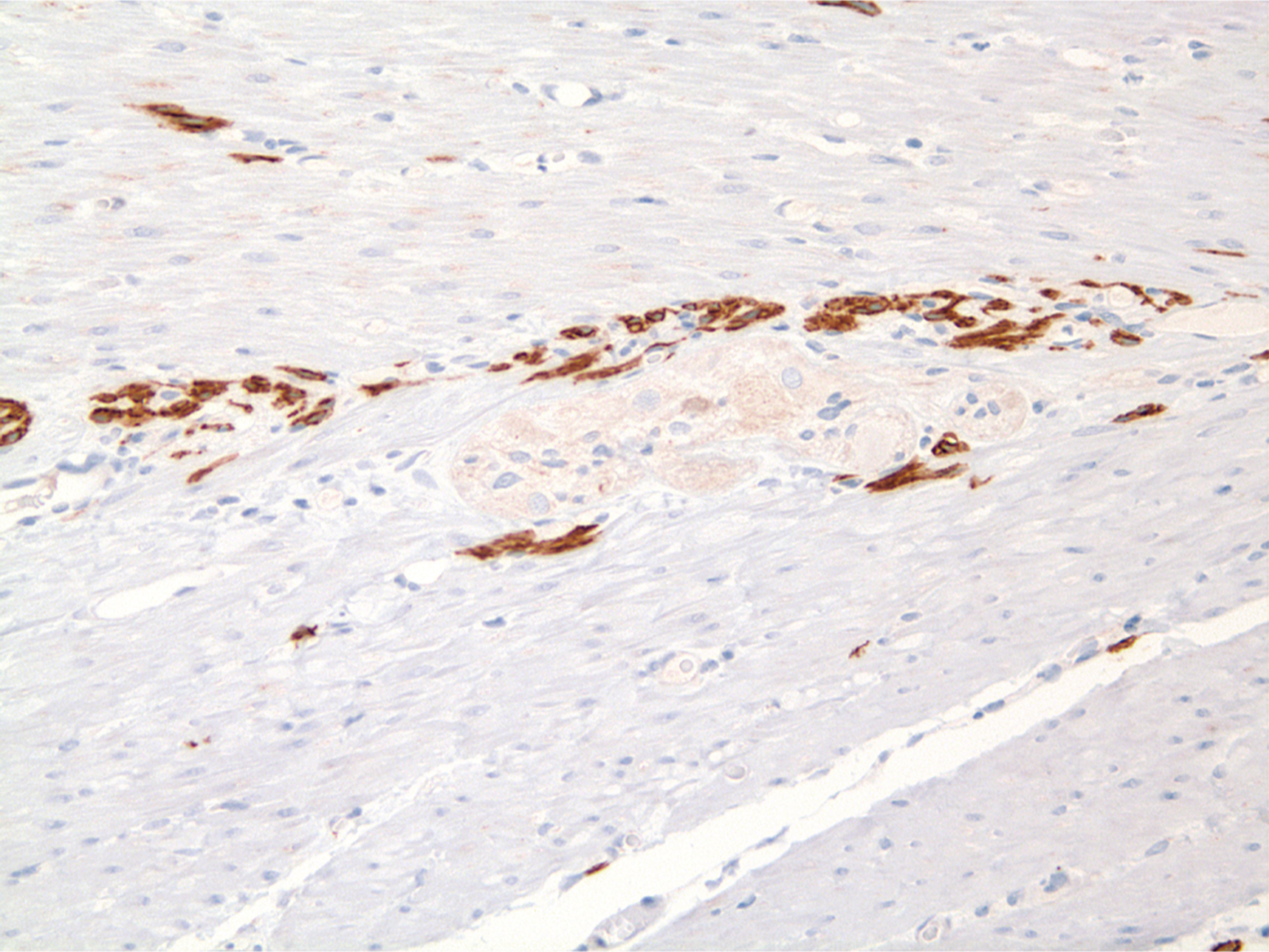 An immunohistochemically stained microscopic view displays linear clusters of positive cells within muscle tissue.
