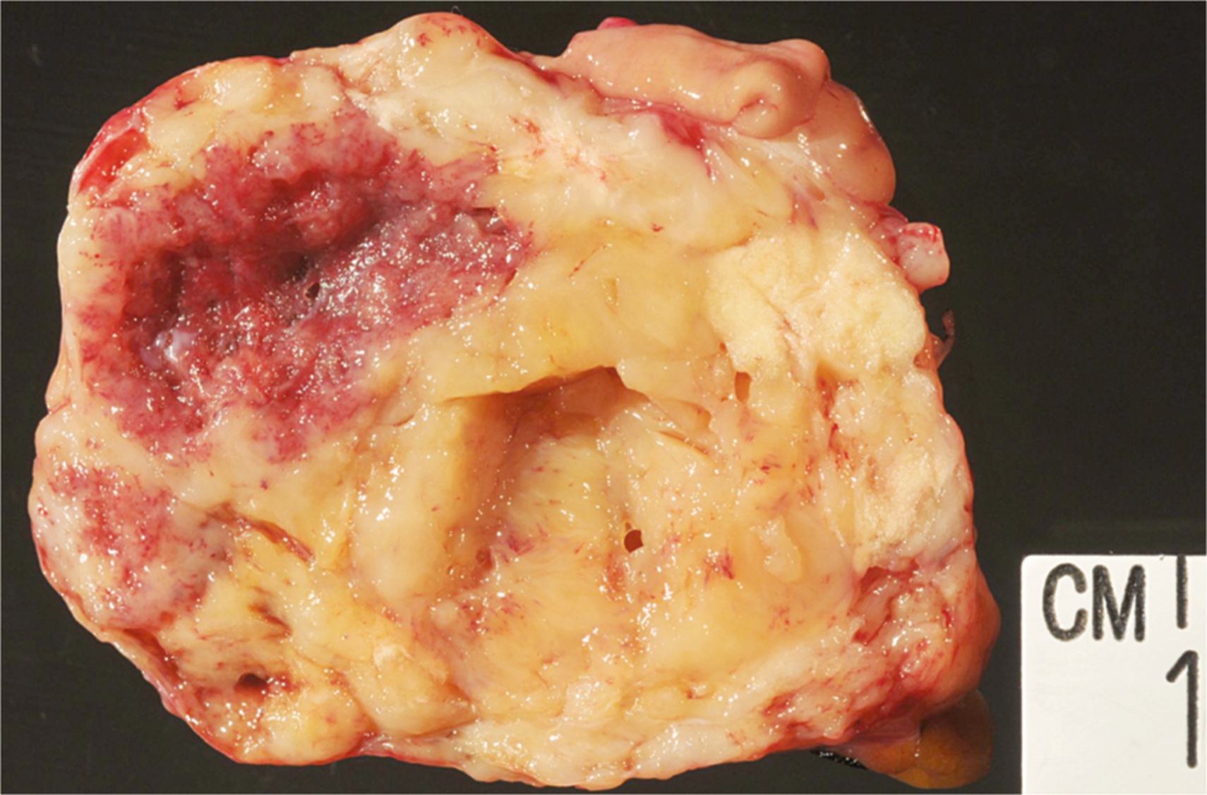 A gross pathology specimen displaying a cut section of a mass with hemorrhagic areas.