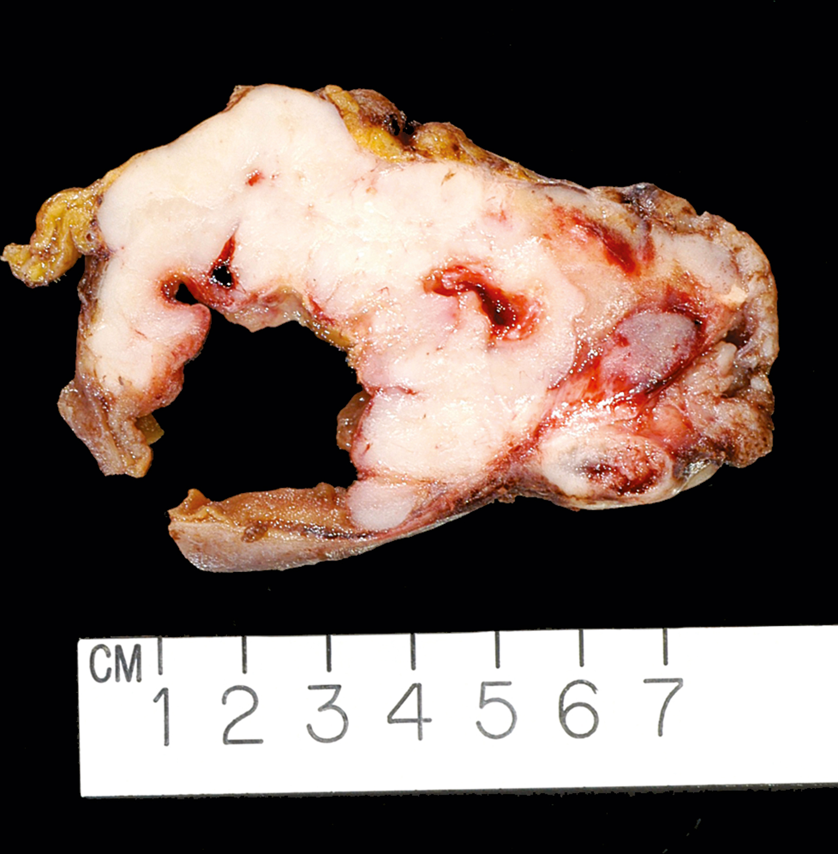 A gross pathology specimen with large, irregular mass bulging from the surface of the bowel with hemorrhagic areas, placed above a centimeter scale.