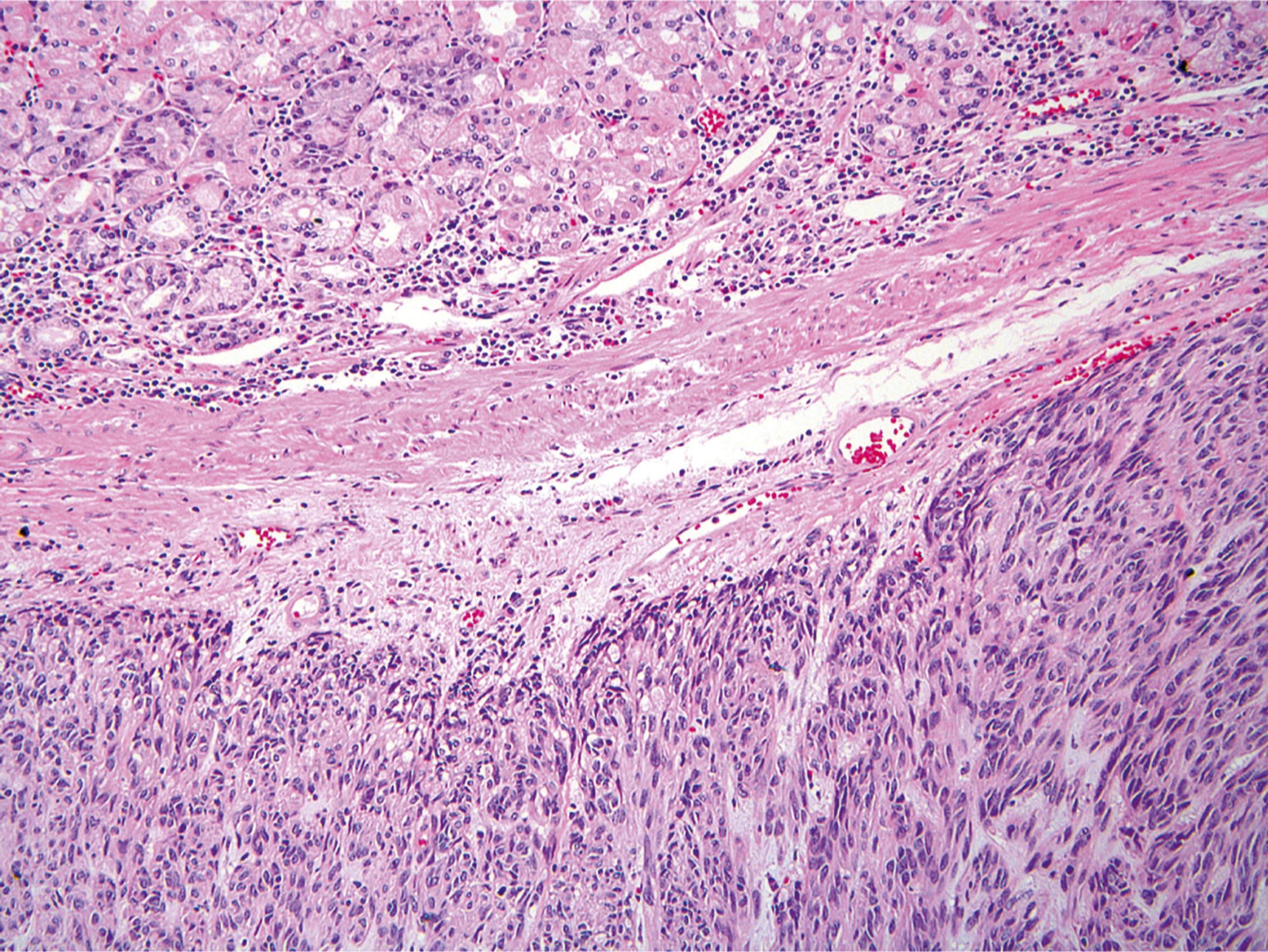 A microscopic view of a spindle cell tumor invading the gastric mucosa.