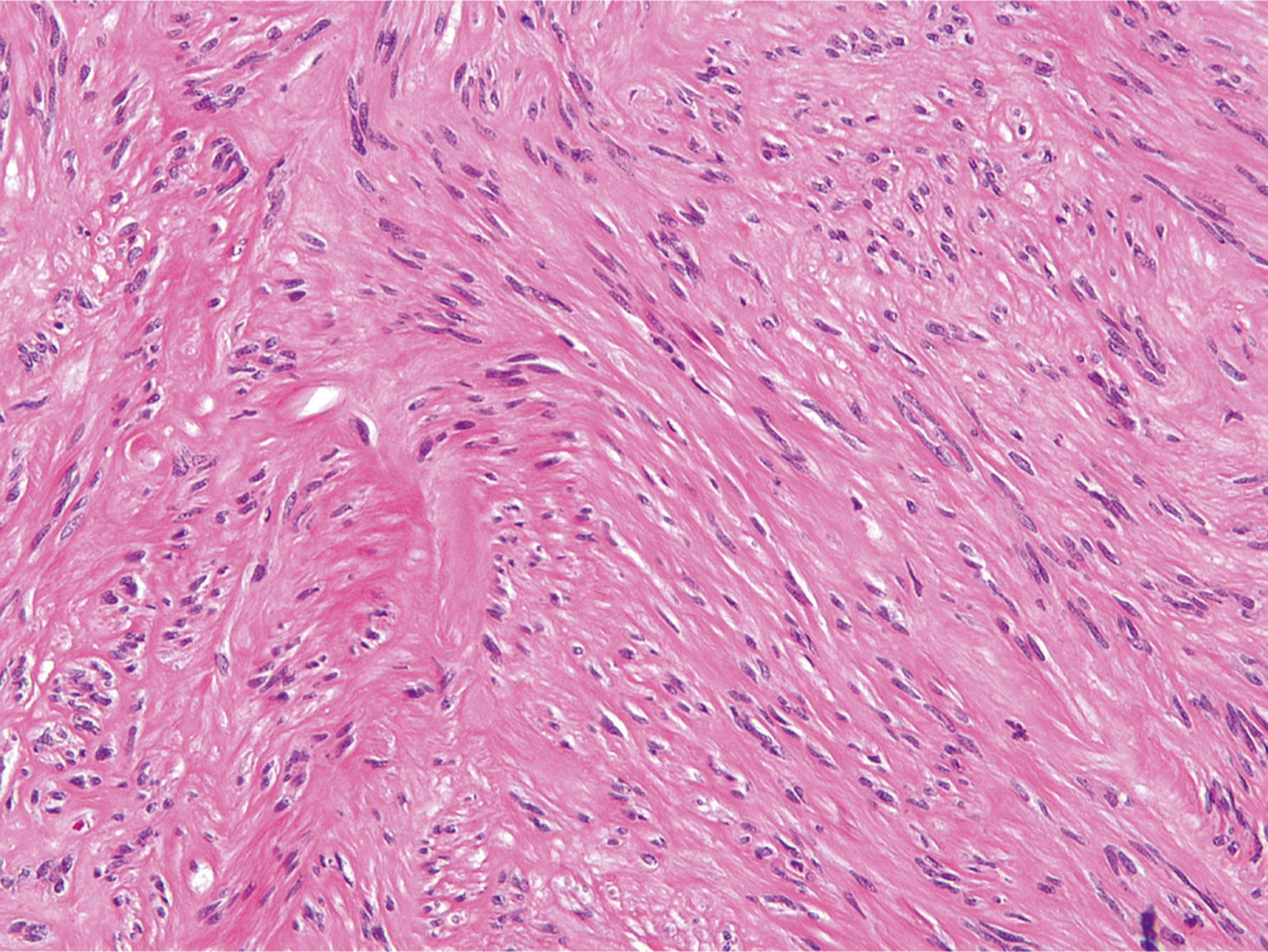 A hematoxylin and eosin-stained microscopic view displays spindle cells with elongated nuclei in fascicles.