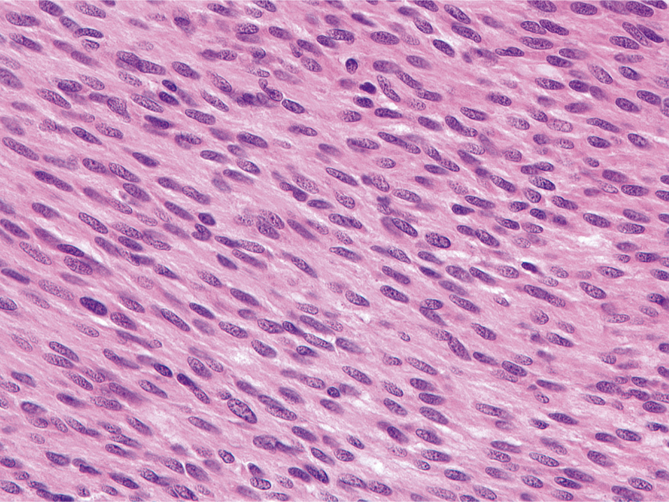 A hematoxylin and eosin stained microscopic view displays spindle cells with wavy nuclei arranged in palisades.
