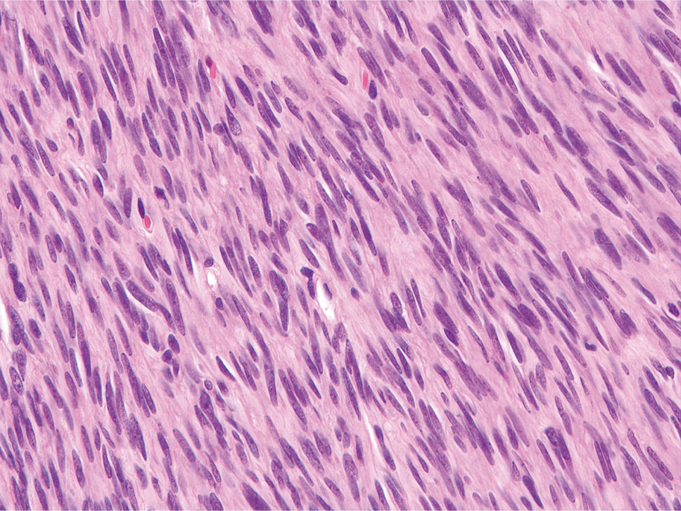 A hematoxylin and eosin stained micrographic view displays densely packed spindle cells with elongated nuclei.
