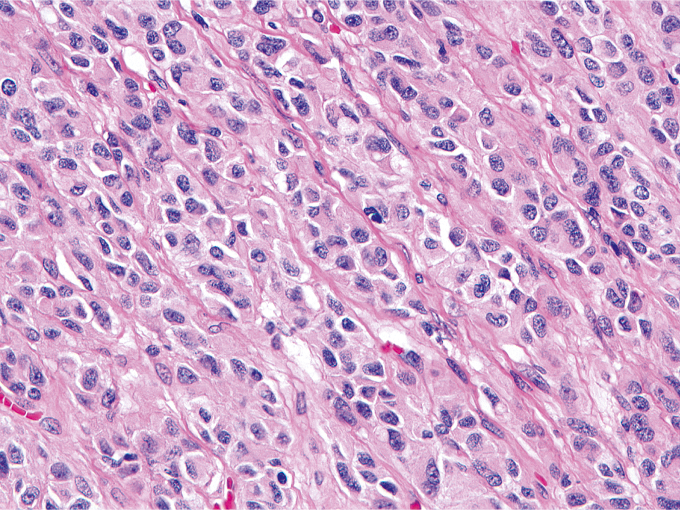 A hematoxylin and eosin-stained microscopic view displays epithelioid cells with round nuclei in a nested pattern.