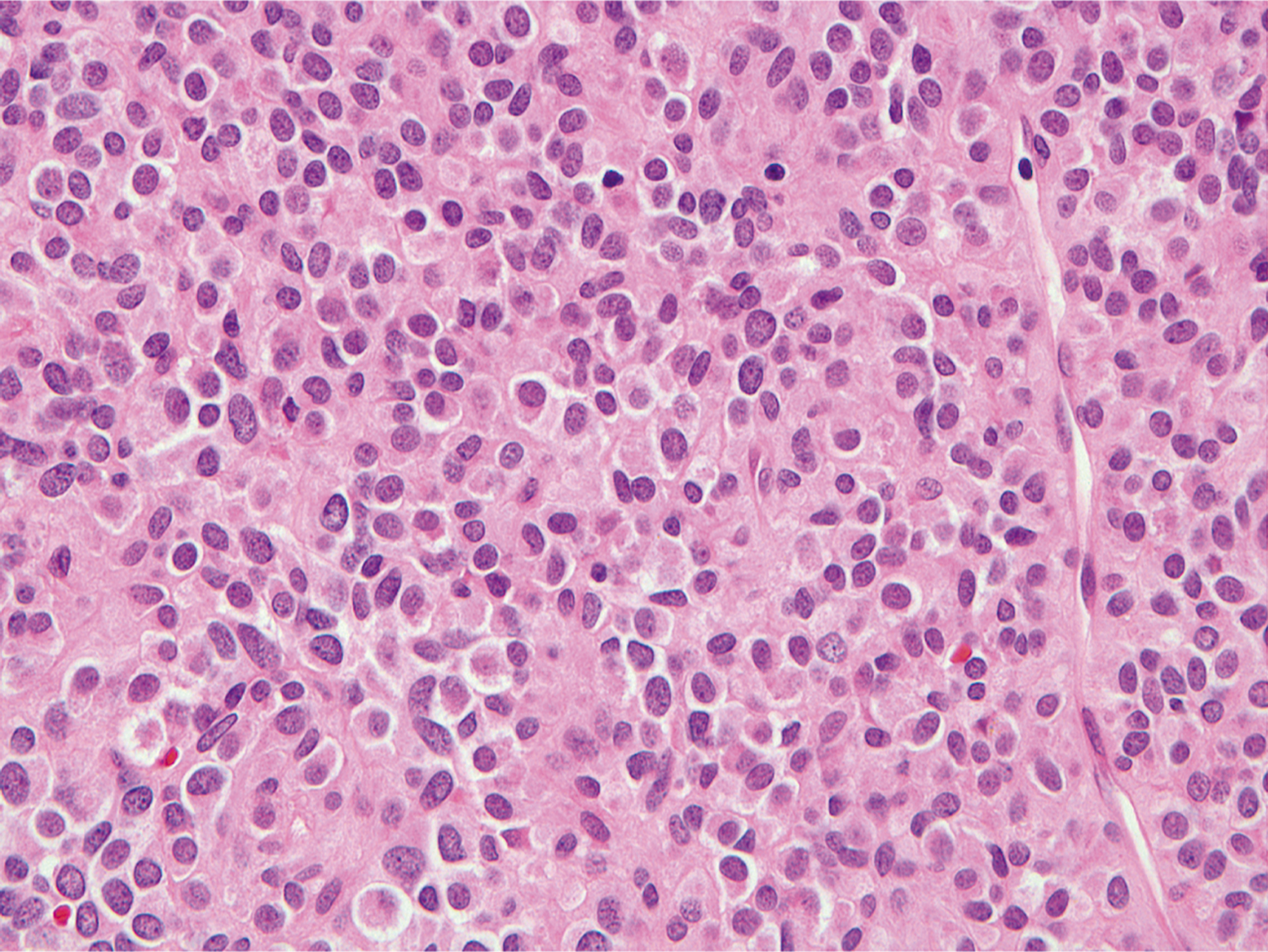 A hematoxylin and eosin-stained microscopic view displays small round cells with a high nuclear-to-cytoplasmic ratio.
