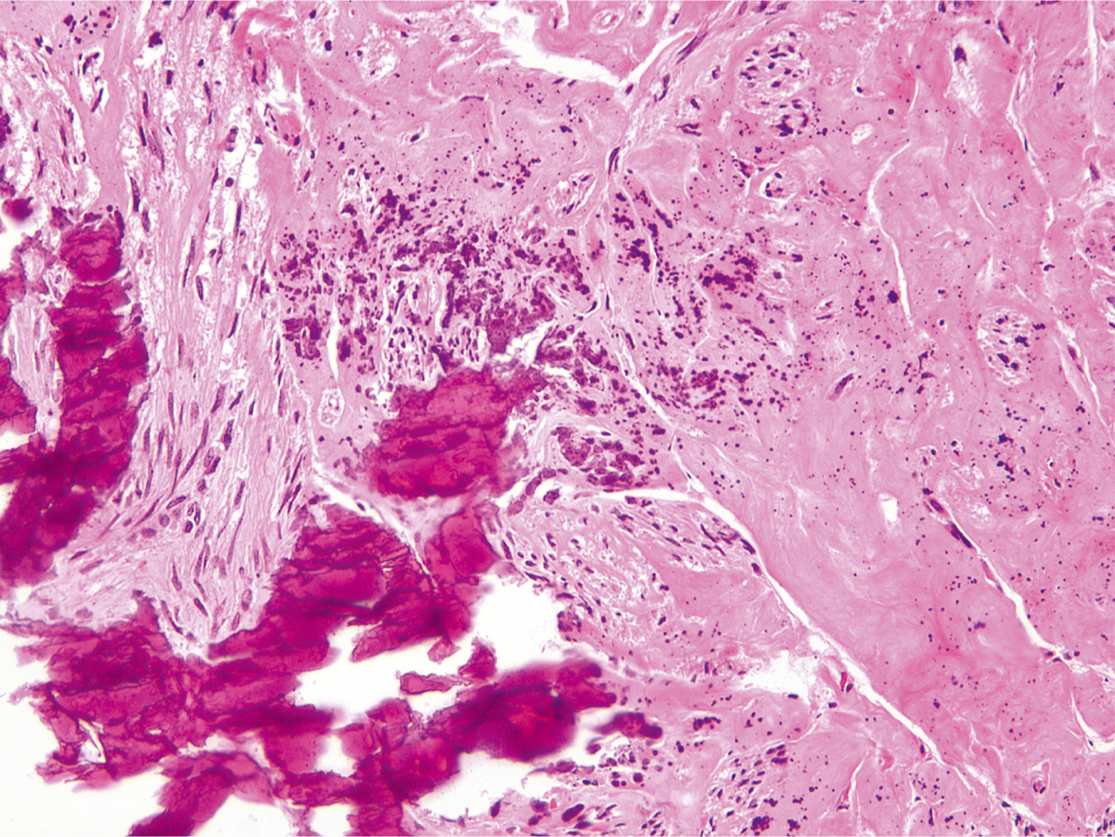 A hematoxylin and eosin stained microscopic view displays dystrophic calcification in fibrous tissue with inflammatory cells.