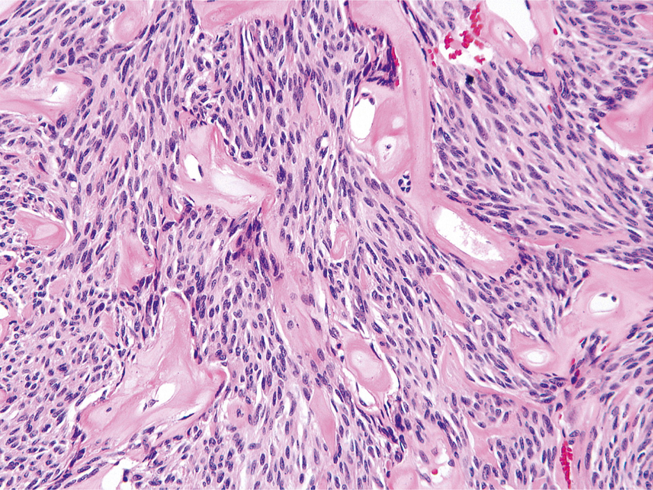A hematoxylin and eosin stained microscopic view displays spindle cells and irregular woven bone formation.