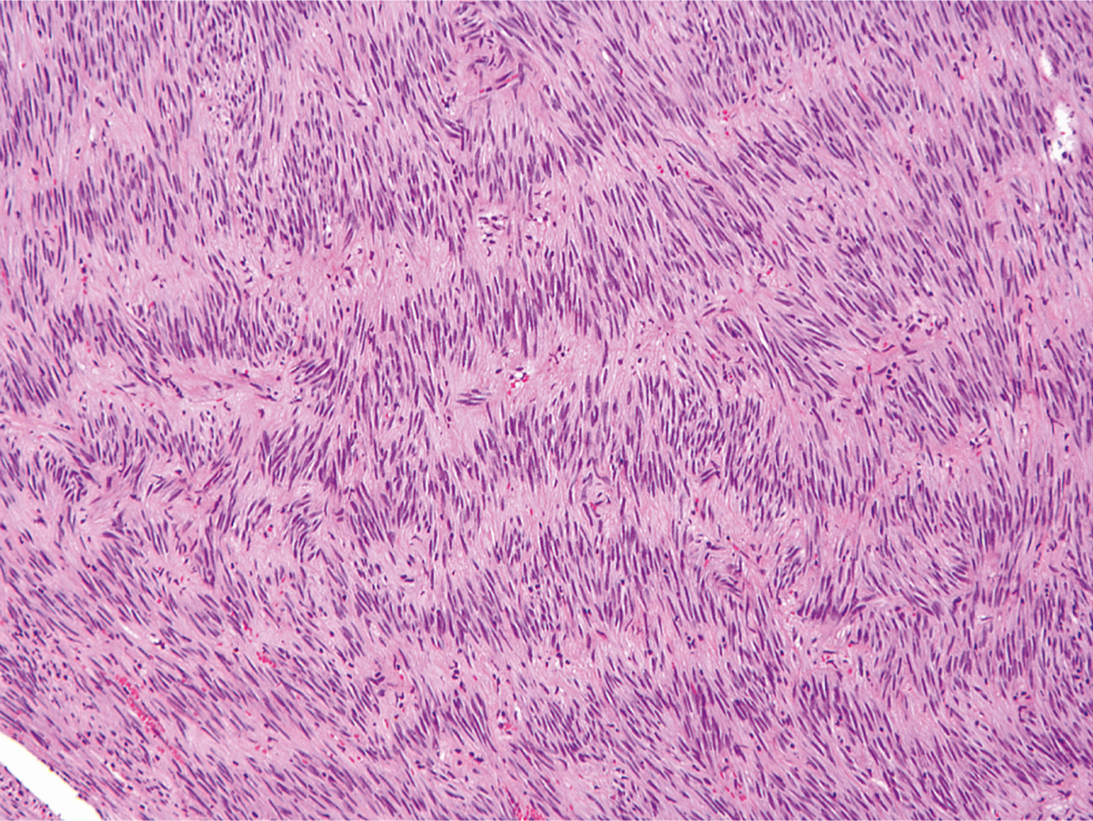A hematoxylin and eosin stained microscopic view displays spindle cells with wavy nuclei arranged in palisades.