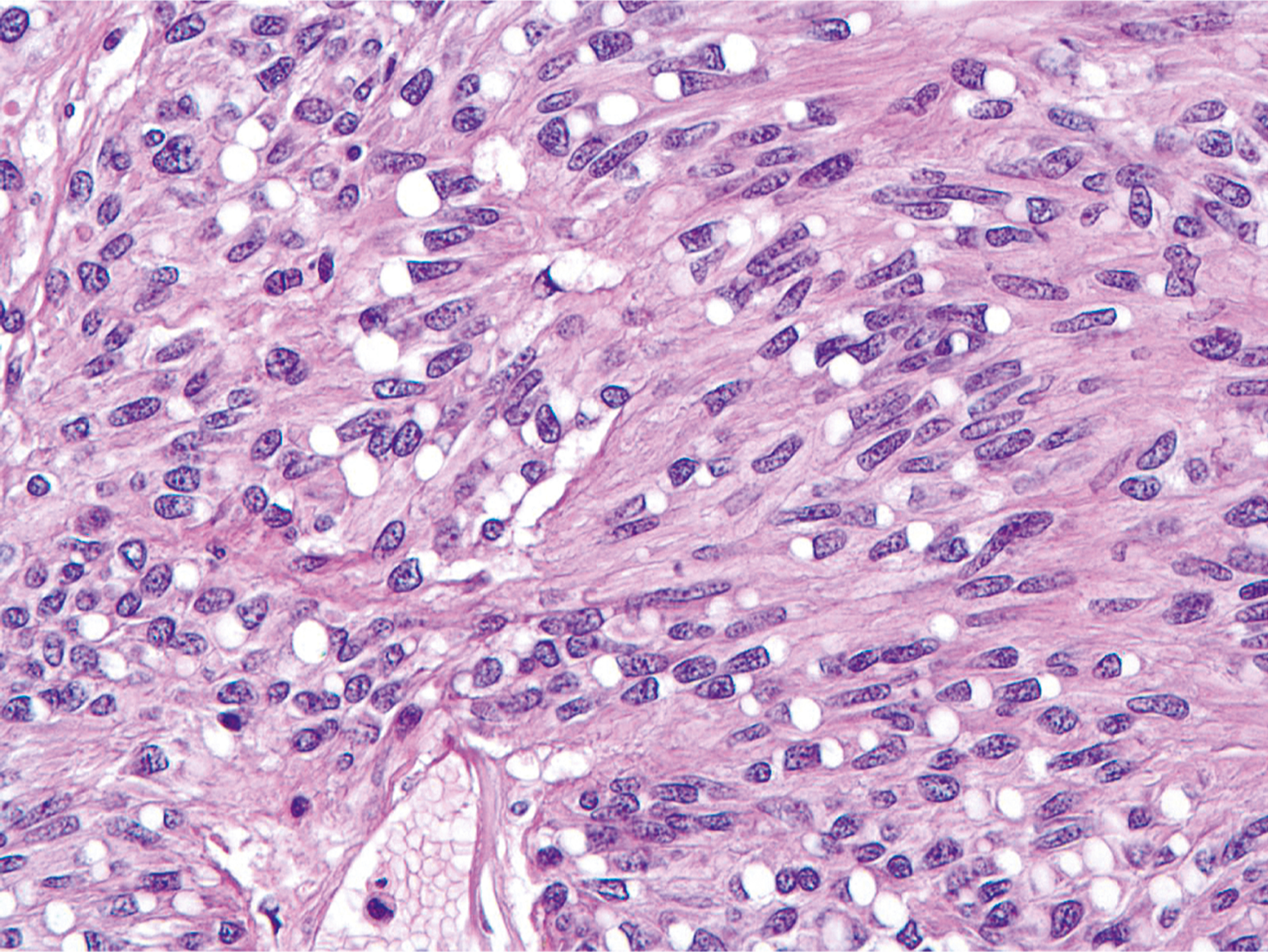 A hematoxylin and eosin-stained microscopic view displays spindle cells and tubular structures with eosinophilic secretions.