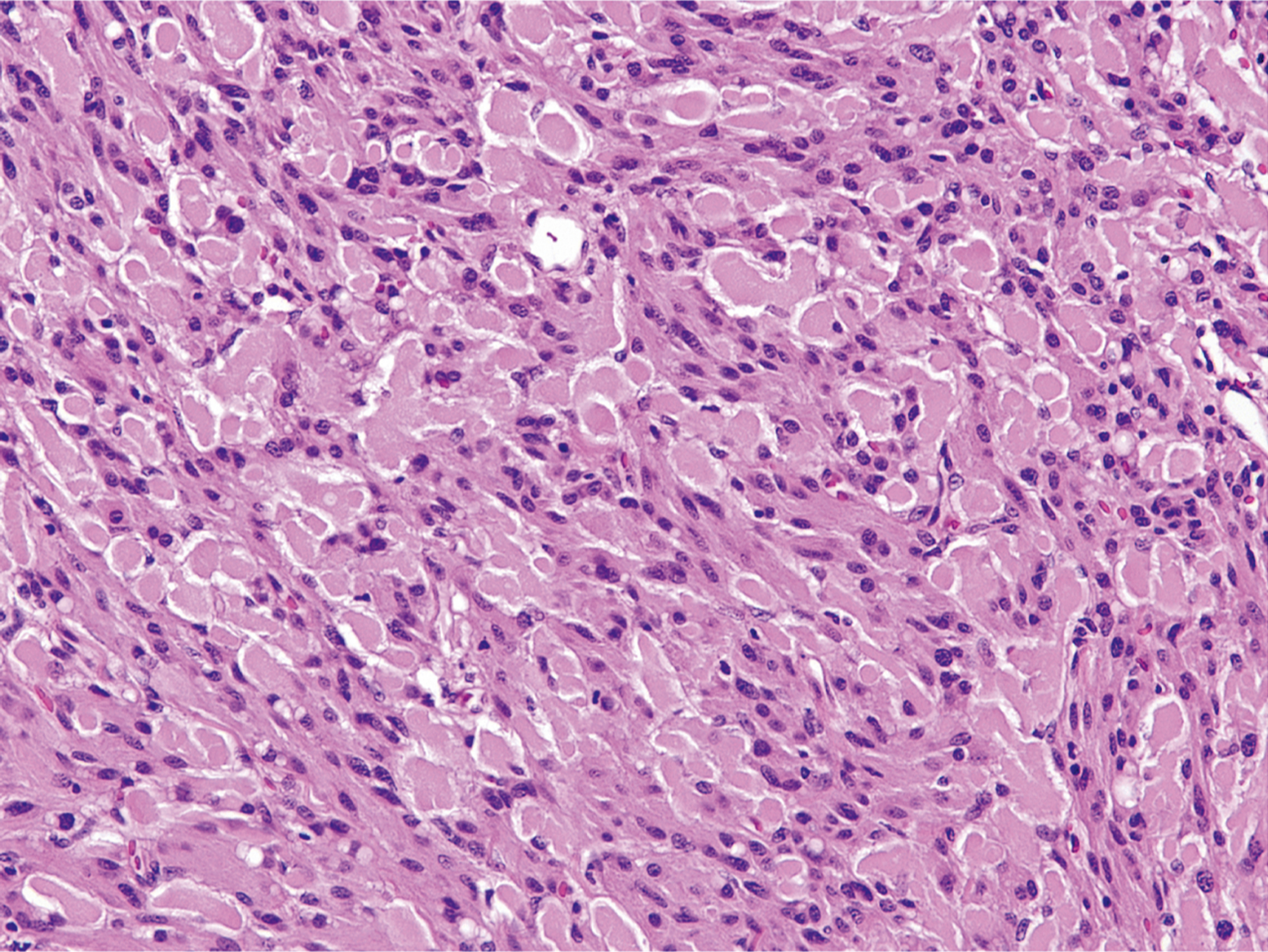 A hematoxylin and eosin stained microscopic view displays spindle cells with perinuclear vacuolization.