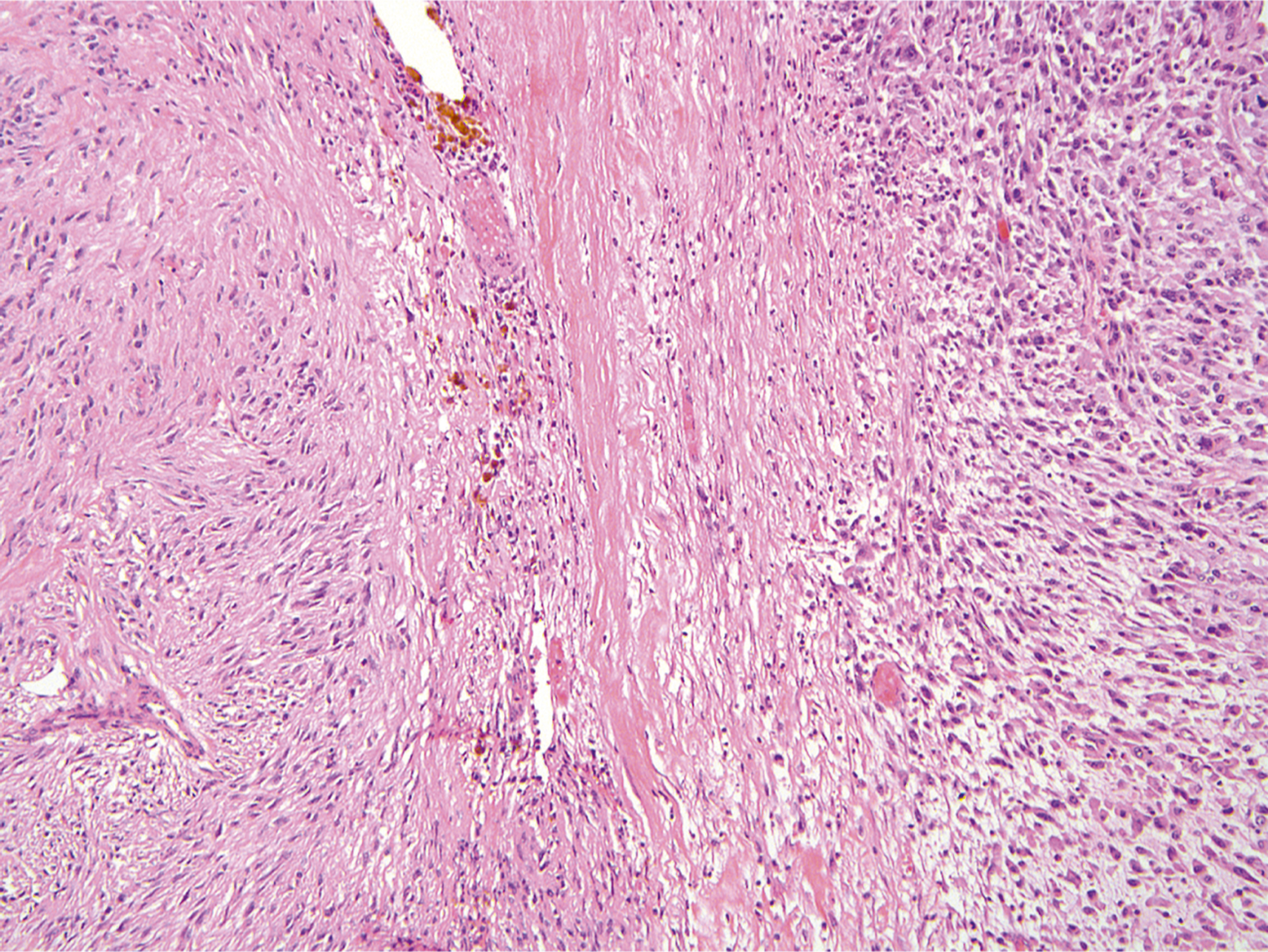 A hematoxylin and eosin stained microscopic view displays a spindle cell tumor with areas of increased cellularity.