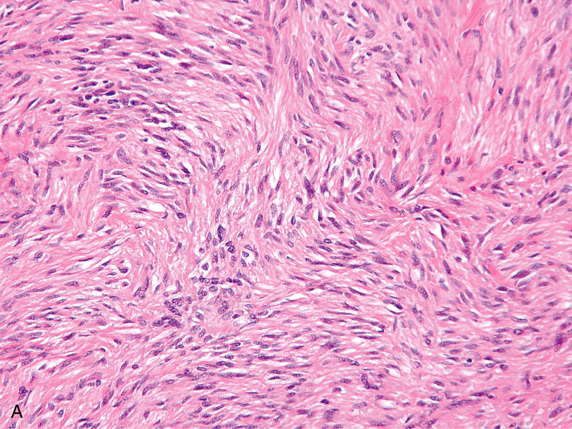 A hematoxylin and eosin stained microscopic view labeled A displays spindle cells arranged in intersecting fascicles.