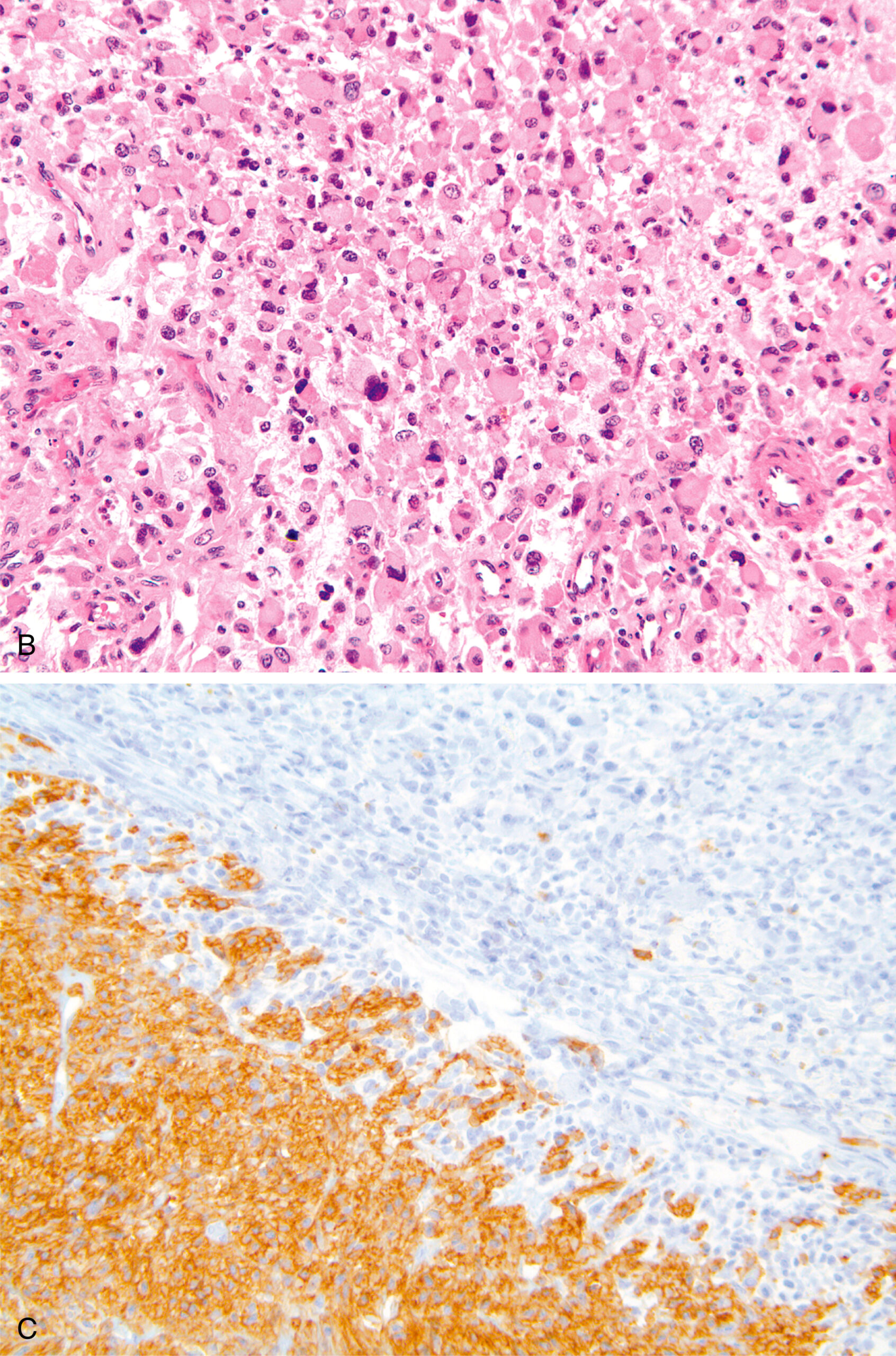 A hematoxylin and eosin stained microscopic view labeled A displays spindle cells arranged in intersecting fascicles.
