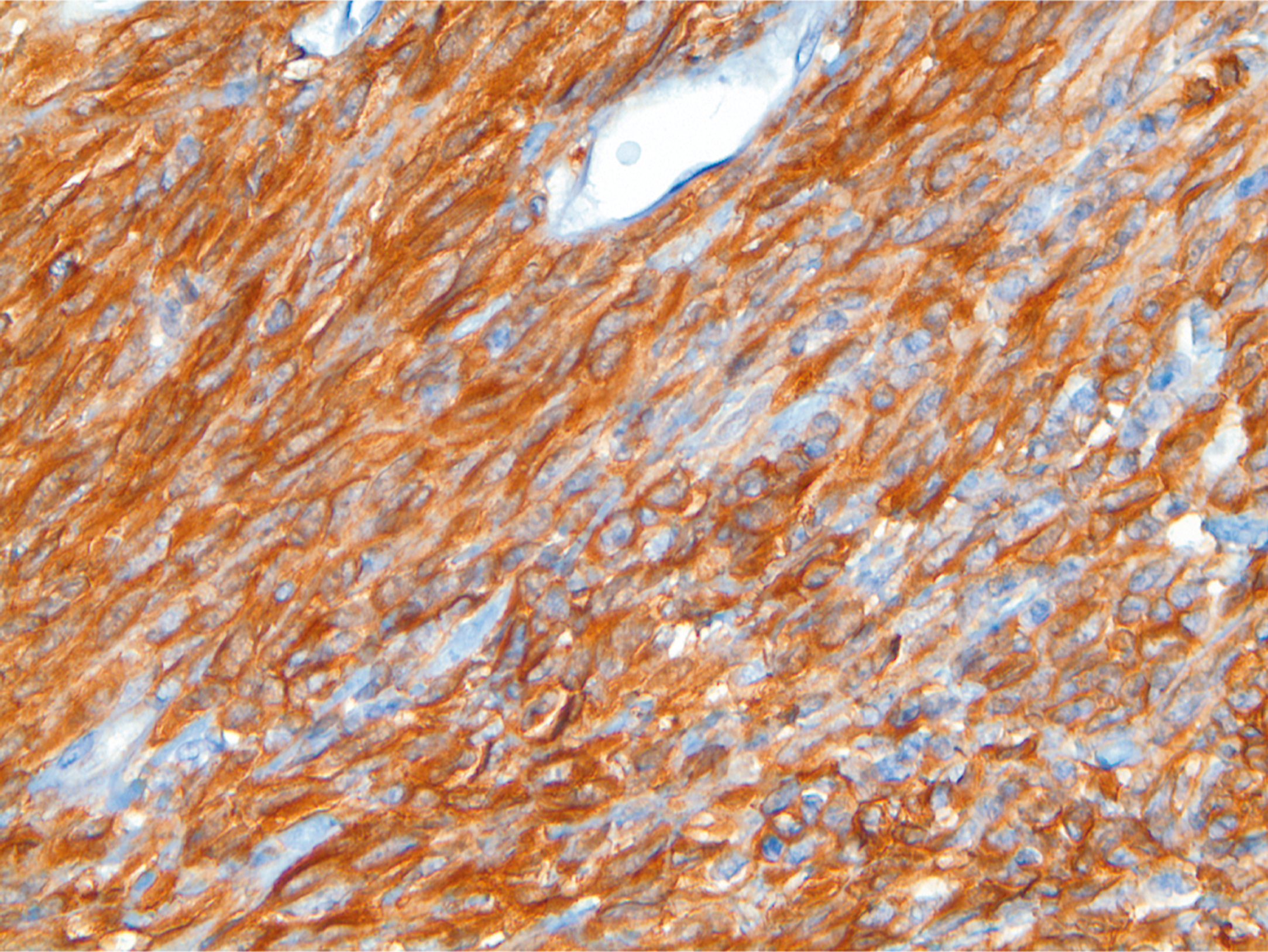 A microscopic view shows warm, brown stained cytoplasm of the cells with round to oval and slightly elongated, and the brown color filling inner areas with the edges of the cells are lighter.