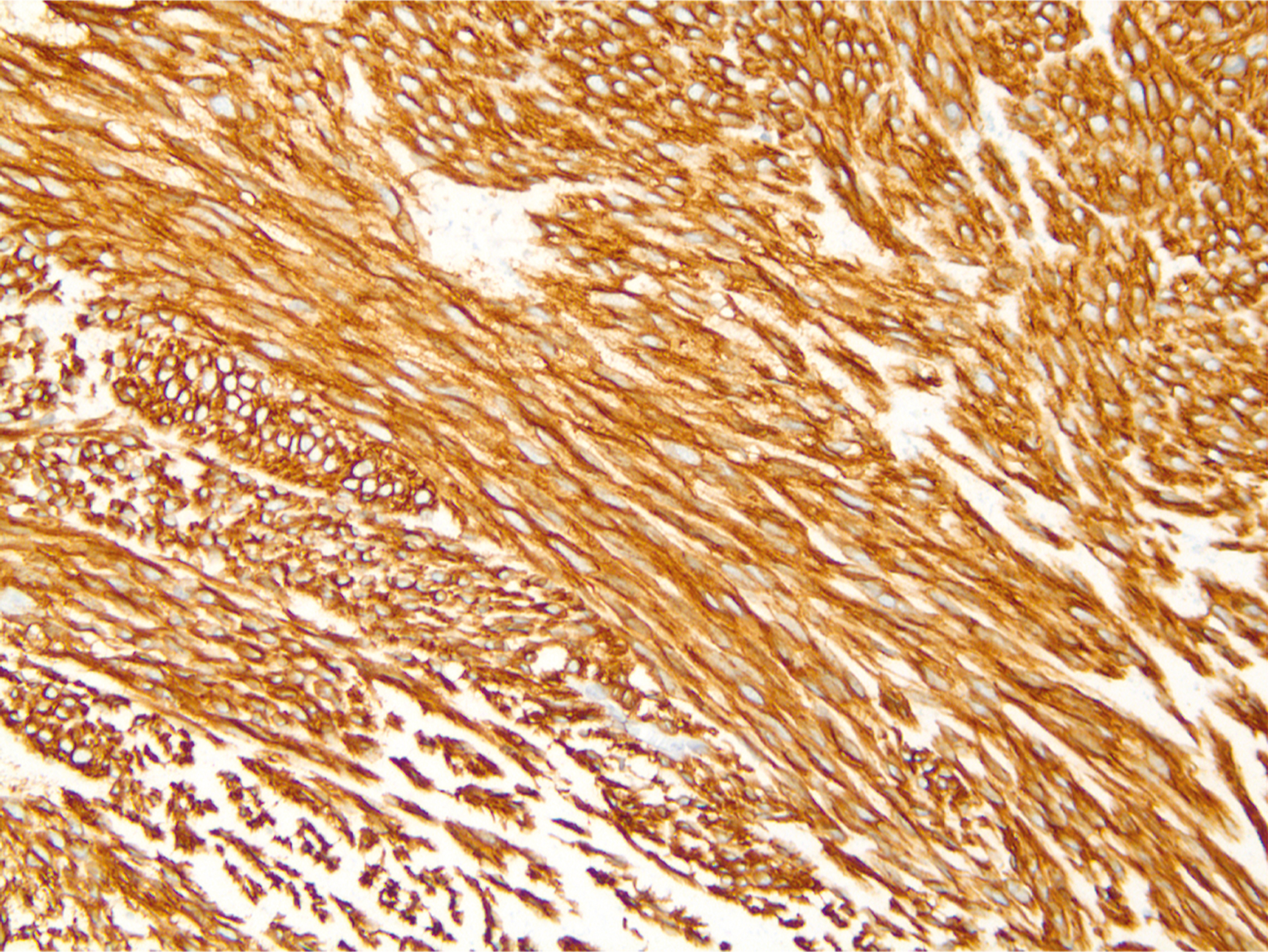 A microscopic view shows long, slender spindle-shaped cells, resembling stretched teardrops, stained with a smooth reddish-brown color highlighting interwoven patterns against a lighter background.