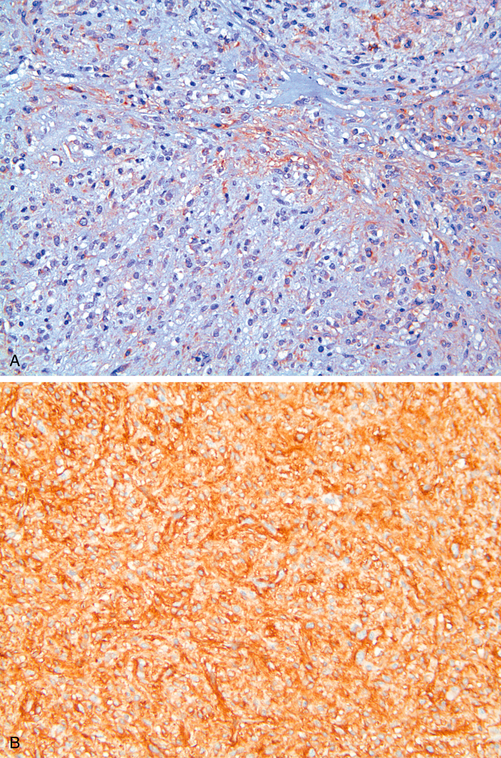 A set of two microscopic views shows an immunohistochemically stained gastrointestinal stromal tumor. The set of two microscopic views labeled B and C shows an immunohistochemically stained gastrointestinal stromal tumor. Part A shows a microscopic view with no visible staining cells that appear pale and unstained, blending into the background. Part B reveals reddish-brown color filling the long, thin, spindle-shaped cells, making them stand out clearly in a flowing, interwoven pattern.
