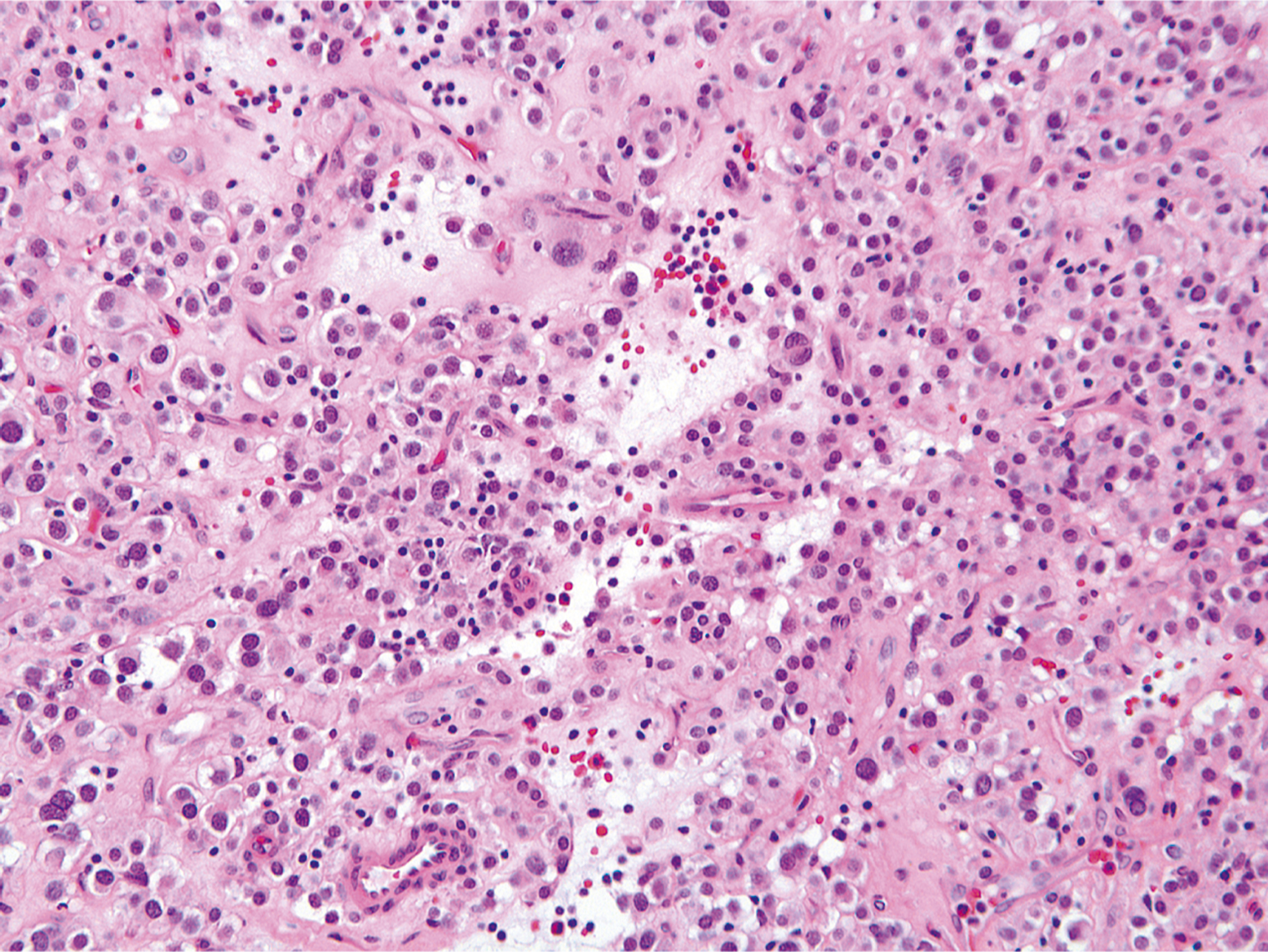 A hematoxylin and eosin stained microscopic view displays atypical cells with abundant glassy cytoplasm and inflammatory infiltrate.