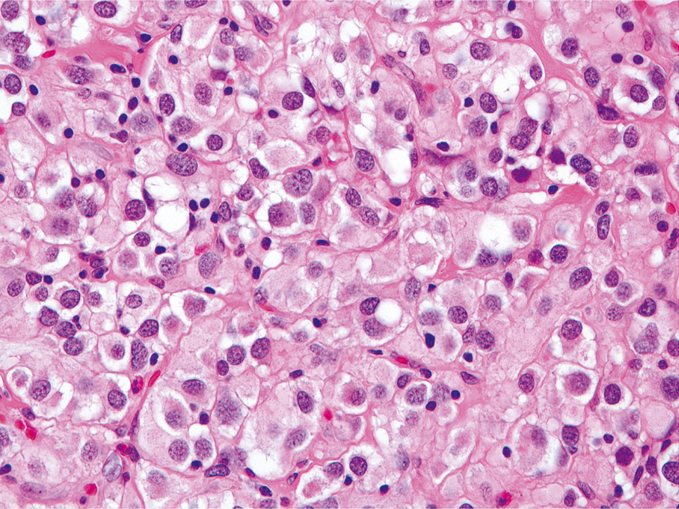 A hematoxylin and eosin stained microscopic view displays signet ring cells infiltrating a fibrous stroma.