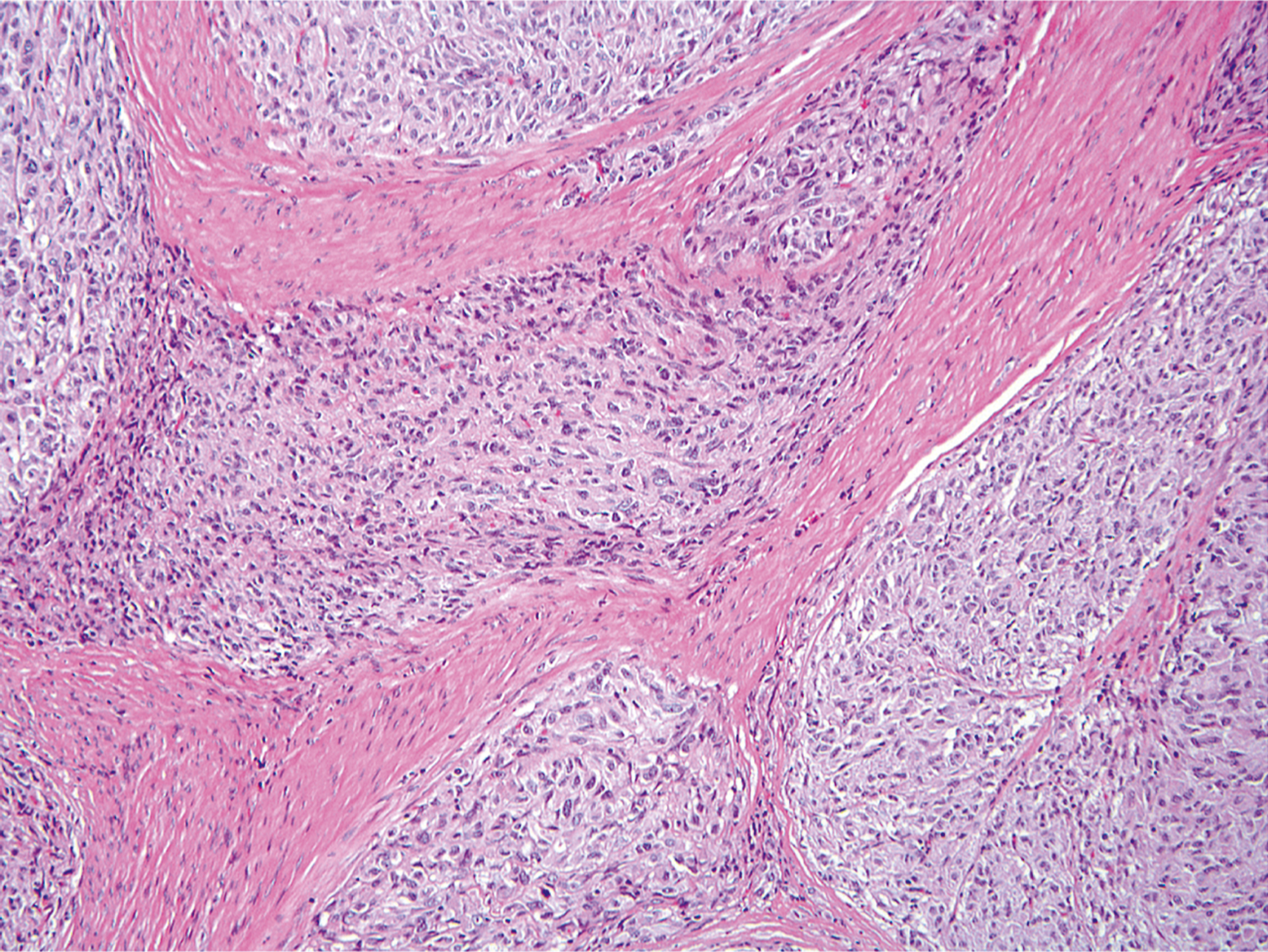 A hematoxylin and eosin-stained microscopic view displays a nodular tumor with central necrosis and peripheral epithelioid cells.