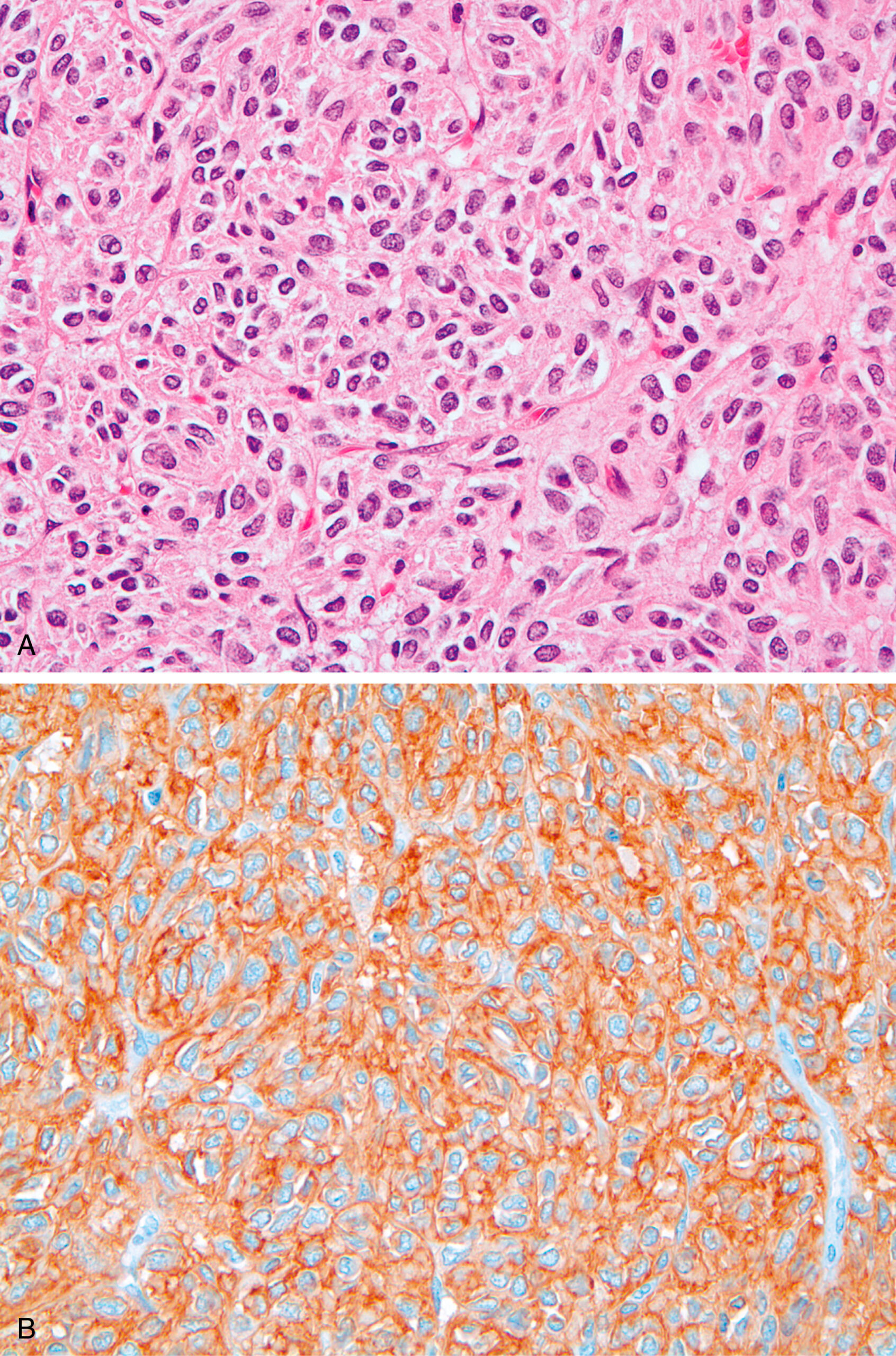 A pair of microscopic visuals displaying Hematoxylin and Eosin-stained tumor cells and strong membranous staining in immunohistochemistry. The set of two microscopic views labeled A and B shows immunohistochemically stained tumor cells. Part A shows an S D H-deficient gastrointestinal stromal tumor with round to oval cells that are smooth, blocky, and arranged in clusters, forming an epithelioid shape similar to tightly packed cubes. Part B shows KIT stained dark brown cells filling the entire cell and making their shape visible against a lighter background.