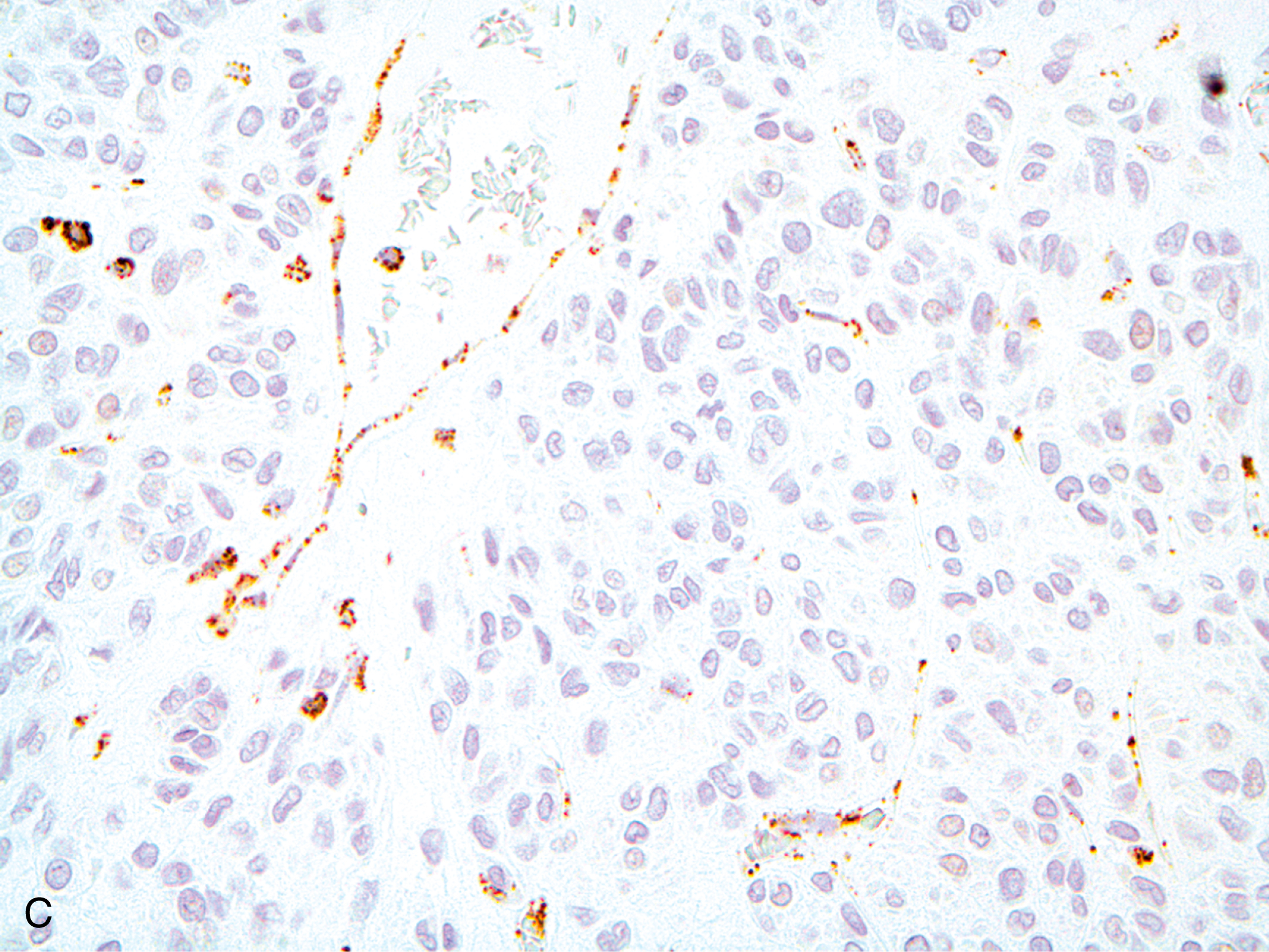 A pair of microscopic visuals displaying Hematoxylin and Eosin-stained tumor cells and strong membranous staining in immunohistochemistry. The set of two microscopic views labeled A and B shows immunohistochemically stained tumor cells. Part A shows an S D H-deficient gastrointestinal stromal tumor with round to oval cells that are smooth, blocky, and arranged in clusters, forming an epithelioid shape similar to tightly packed cubes. Part B shows KIT stained dark brown cells filling the entire cell and making their shape visible against a lighter background.