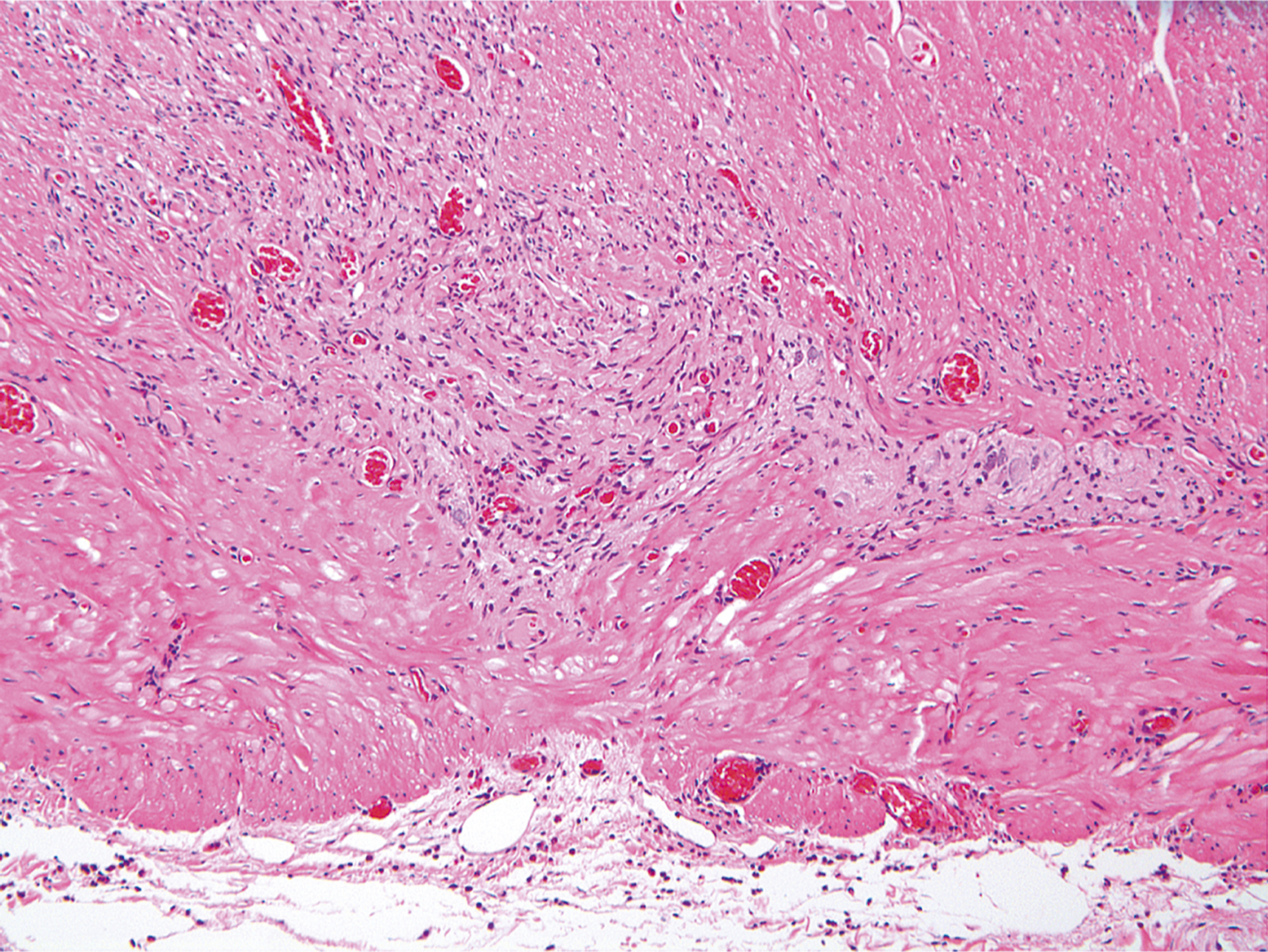 A hematoxylin and eosin stained microscopic view displays an inflammatory infiltrate in nerve tissue.