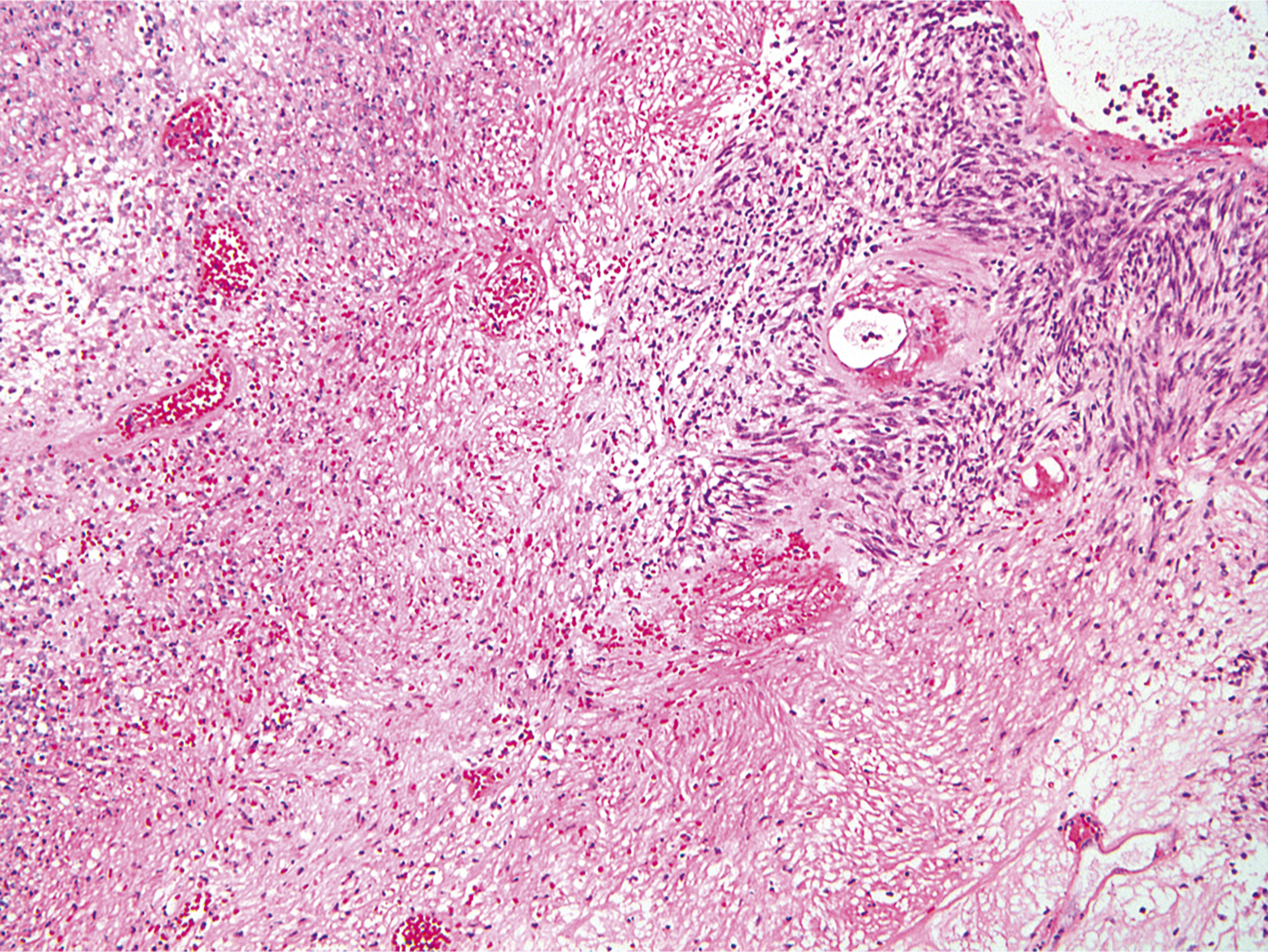 A microscopic view shows large areas of tissue death, appearing as dark, empty regions, with small clusters of viable tumor cells around blood vessels in the upper right corner.
