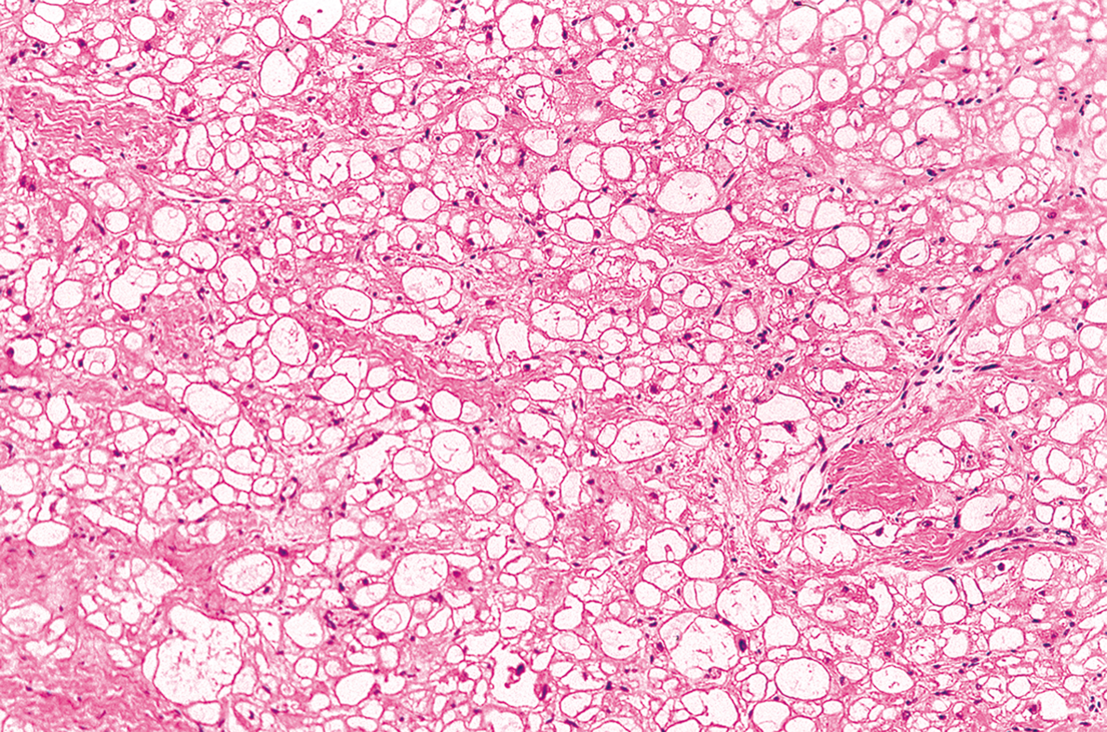 A histological section showing large polygonal spider cells with prominent cytoplasmic vacuoles consistent with cardiac rhabdomyoma.