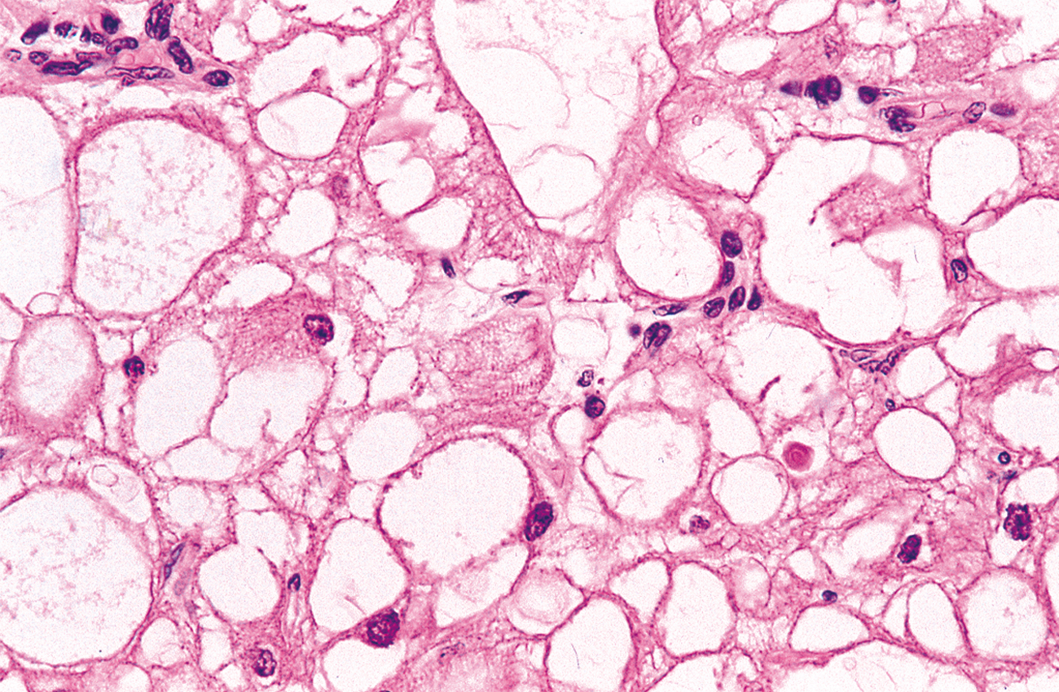 A microscopic view of tissue with large, irregularly shaped cells and smaller, dark-stained nuclei scattered throughout.
