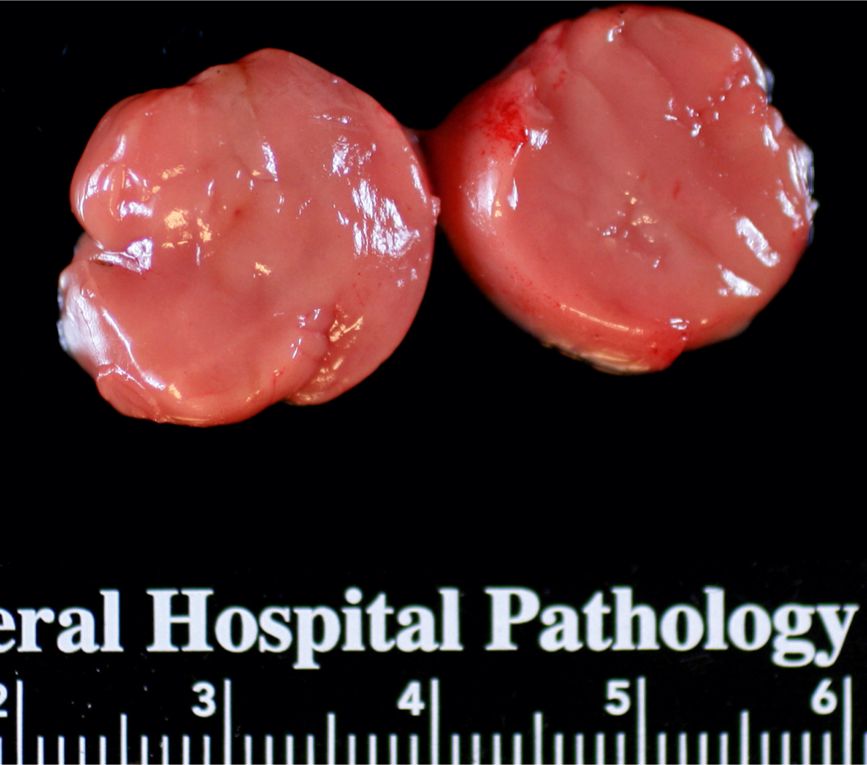 A close-up photo of two round, smooth, and moist tissue samples placed side by side. The photo depicts two round, smooth, and moist tissue samples. The samples have a glistened appearance with visible striations on their surfaces. They appear to be freshly cut, with slightly irregular edges. Below the samples, a labeled measurement scale is visible, with numbers from three to six clearly marked. The text General Hospital Pathology is partially visible, positioned above the measurement scale.