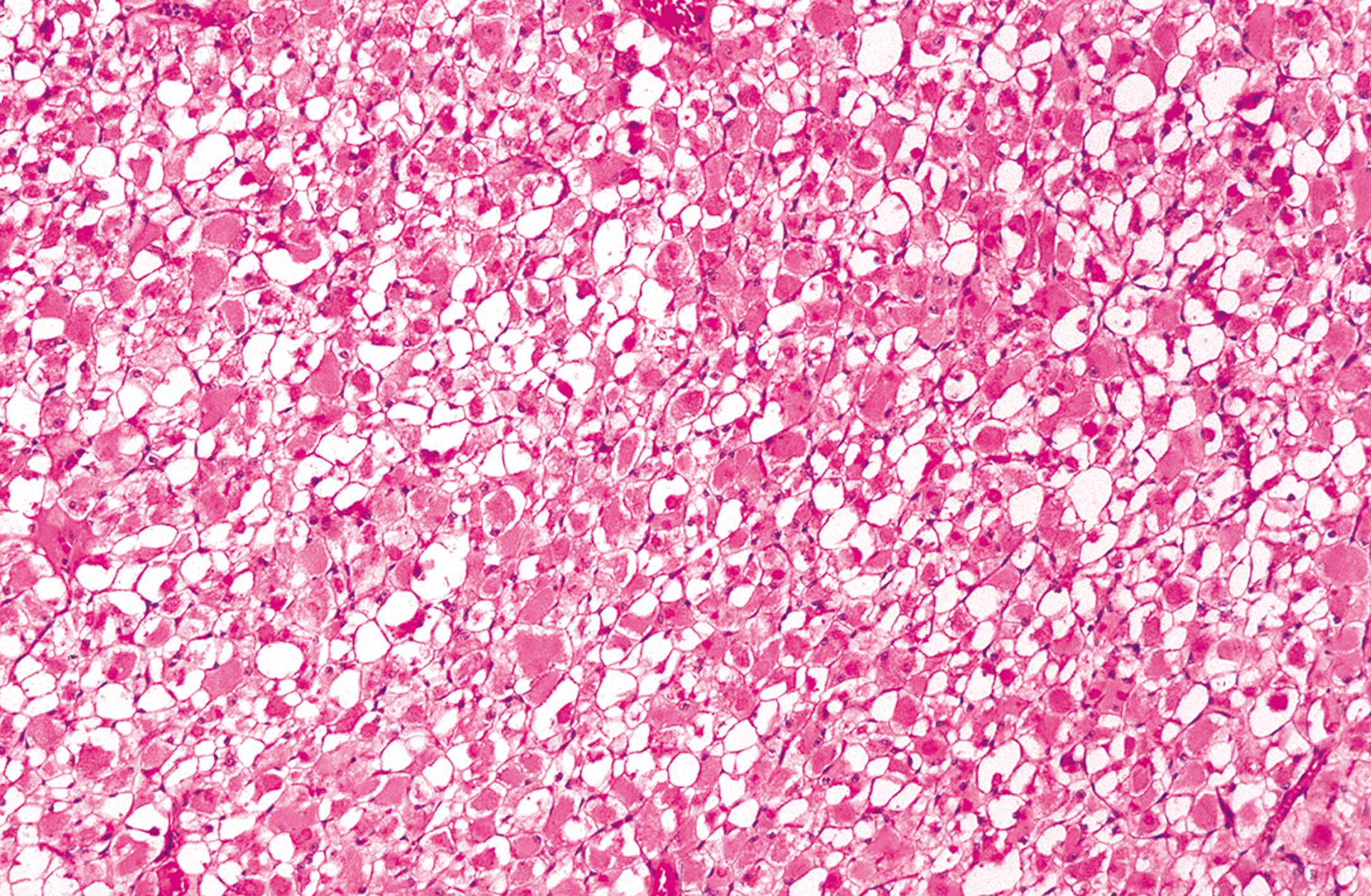 A low-power histological view of adult rhabdomyoma shows a mix of eosinophilic polygonal cells and vacuolated cells.